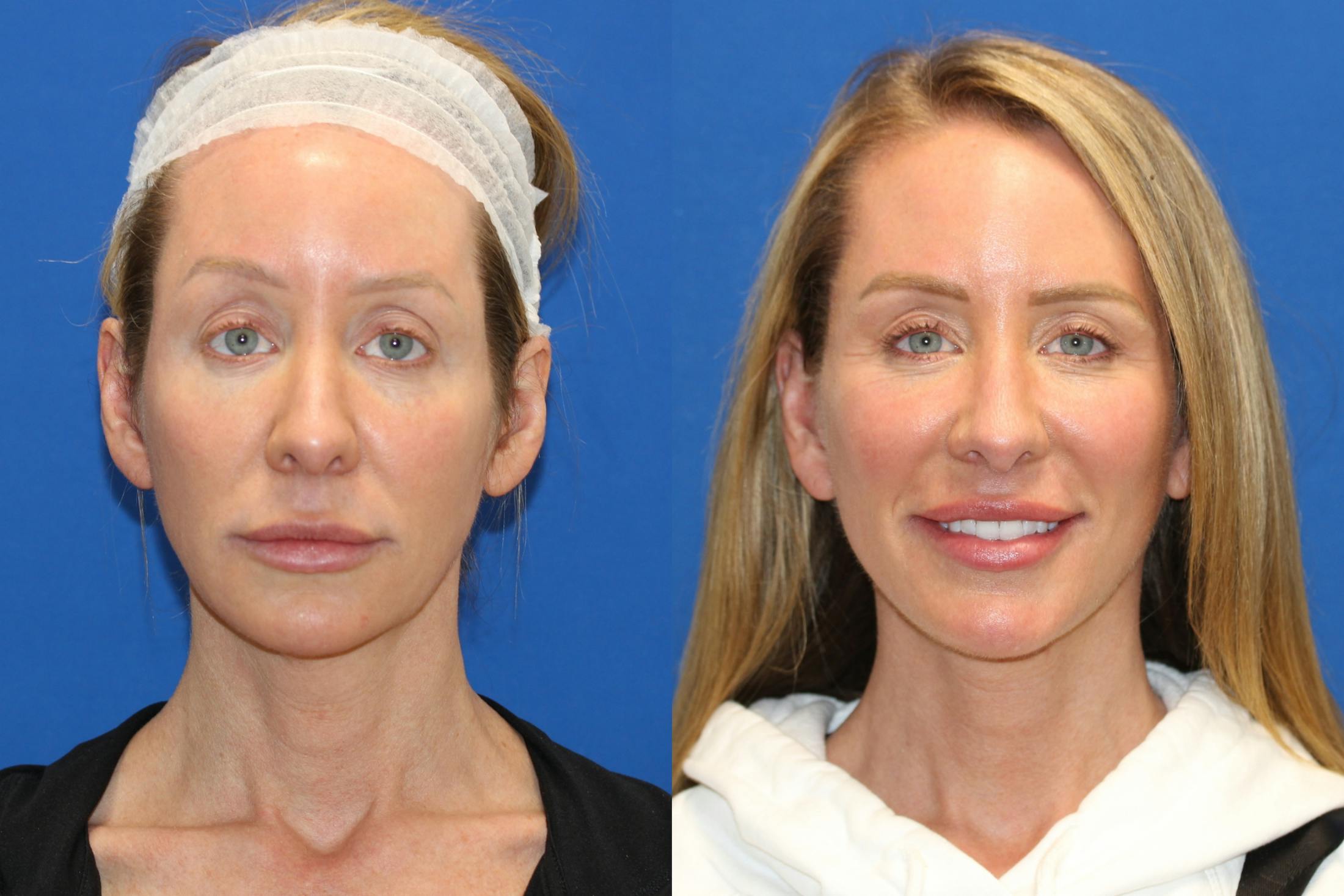 Vertical Restore® / Facial Rejuvenation Before & After Gallery - Patient 76129747 - Image 1
