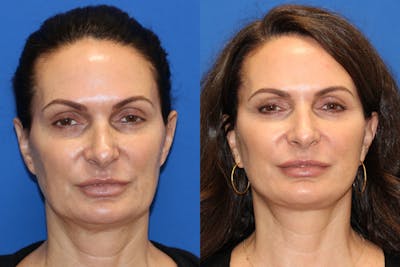 Vertical Restore® / Facial Rejuvenation Before & After Gallery - Patient 77320110 - Image 1