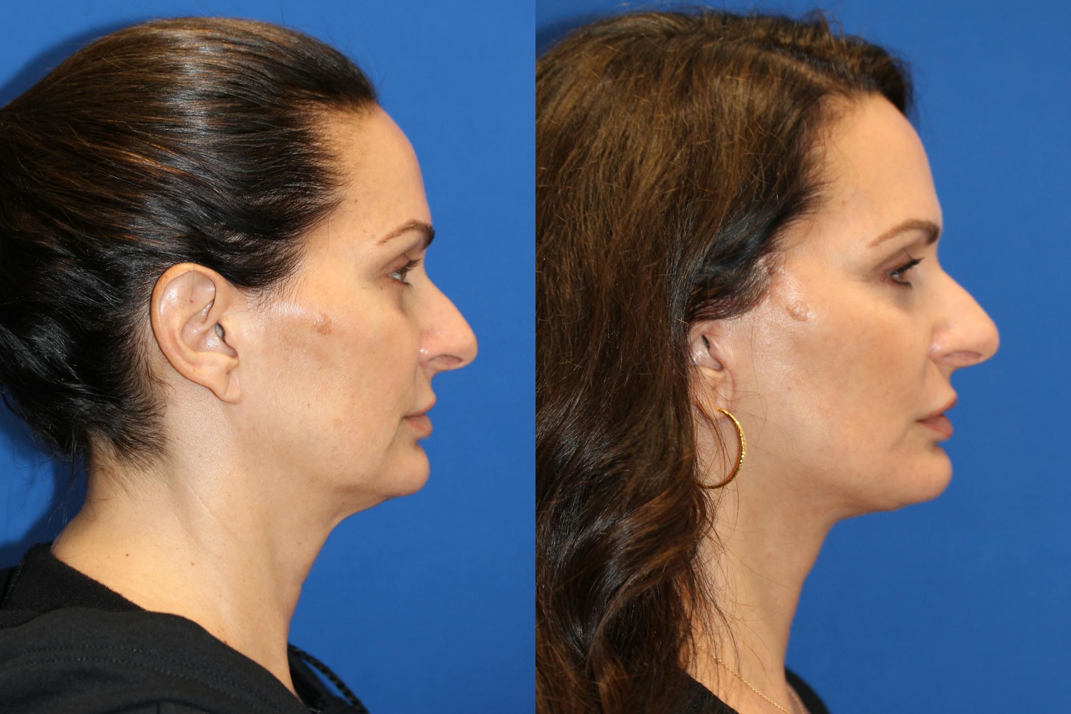 Vertical Restore® / Facial Rejuvenation Before & After Gallery - Patient 77320110 - Image 4