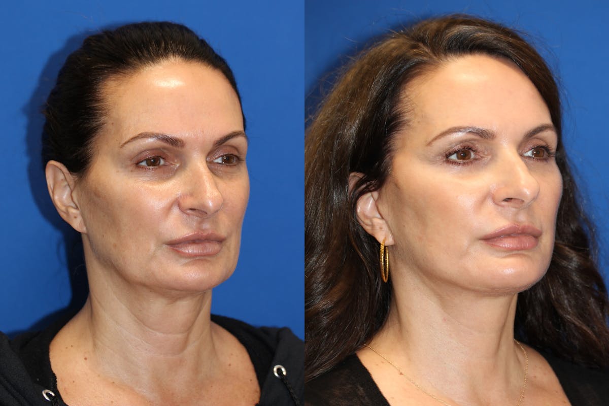 Vertical Restore® / Facial Rejuvenation Before & After Gallery - Patient 77320110 - Image 2