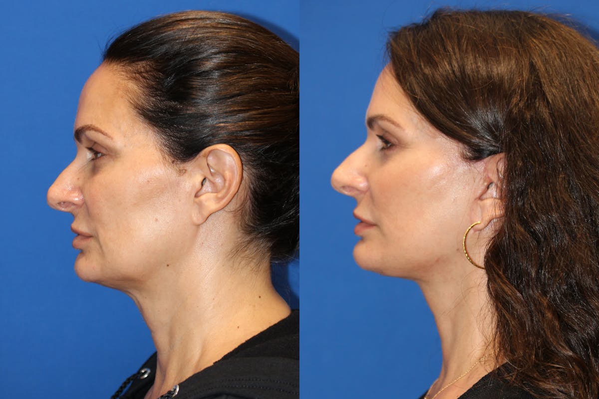 Vertical Restore® / Facial Rejuvenation Before & After Gallery - Patient 77320110 - Image 5