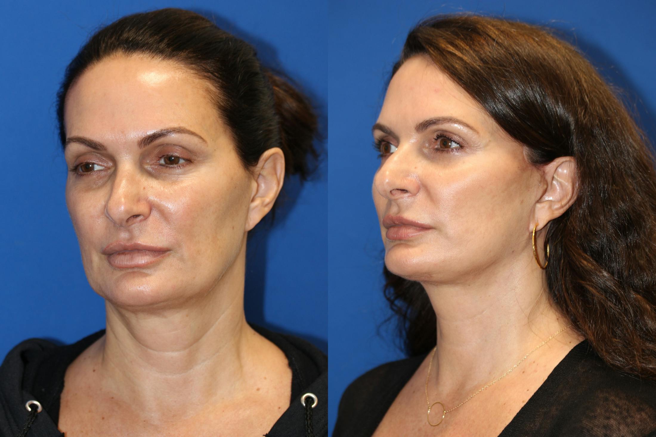 Vertical Restore® / Facial Rejuvenation Before & After Gallery - Patient 77320110 - Image 3