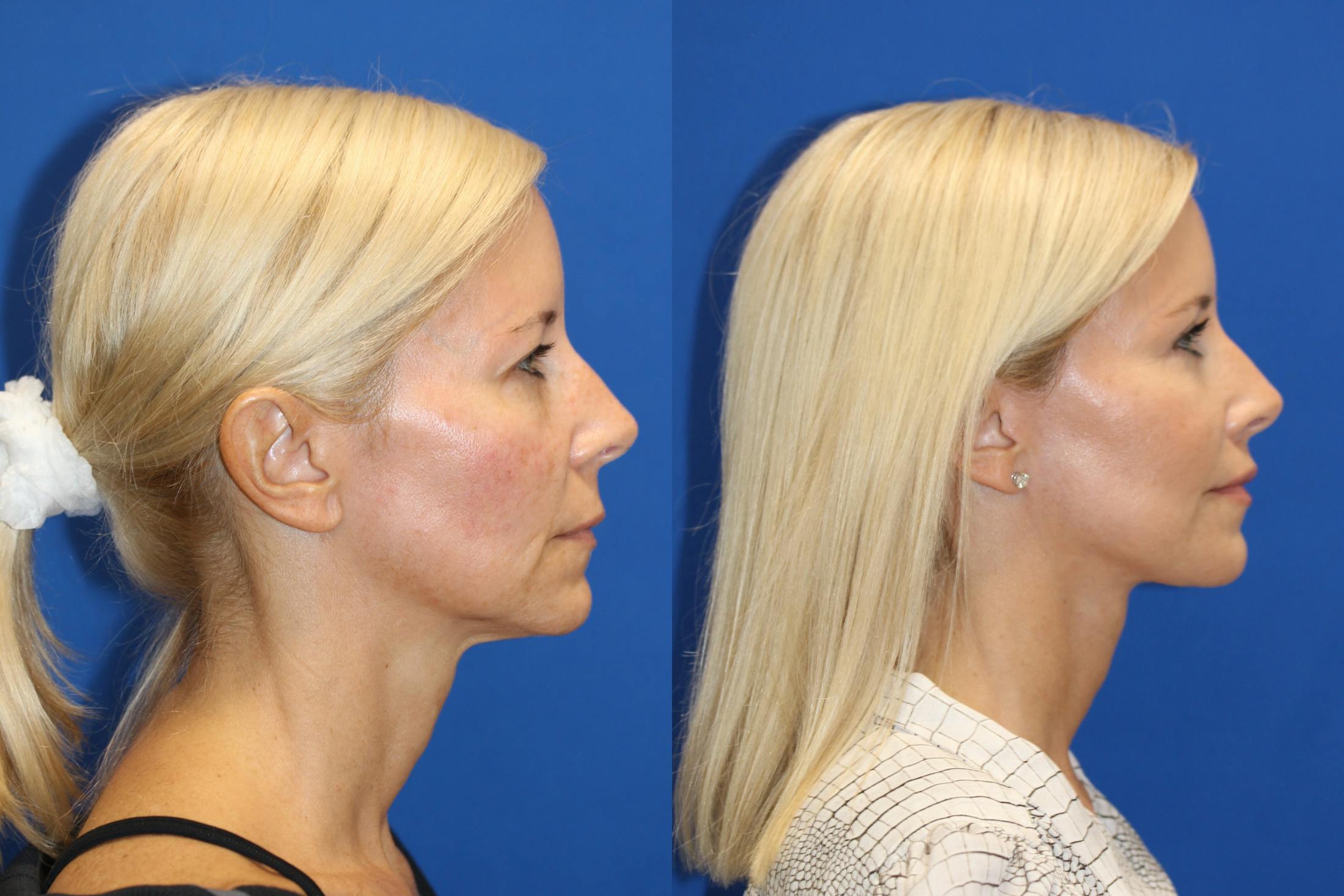 Fat Transfer Before & After Gallery - Patient 86306238 - Image 3