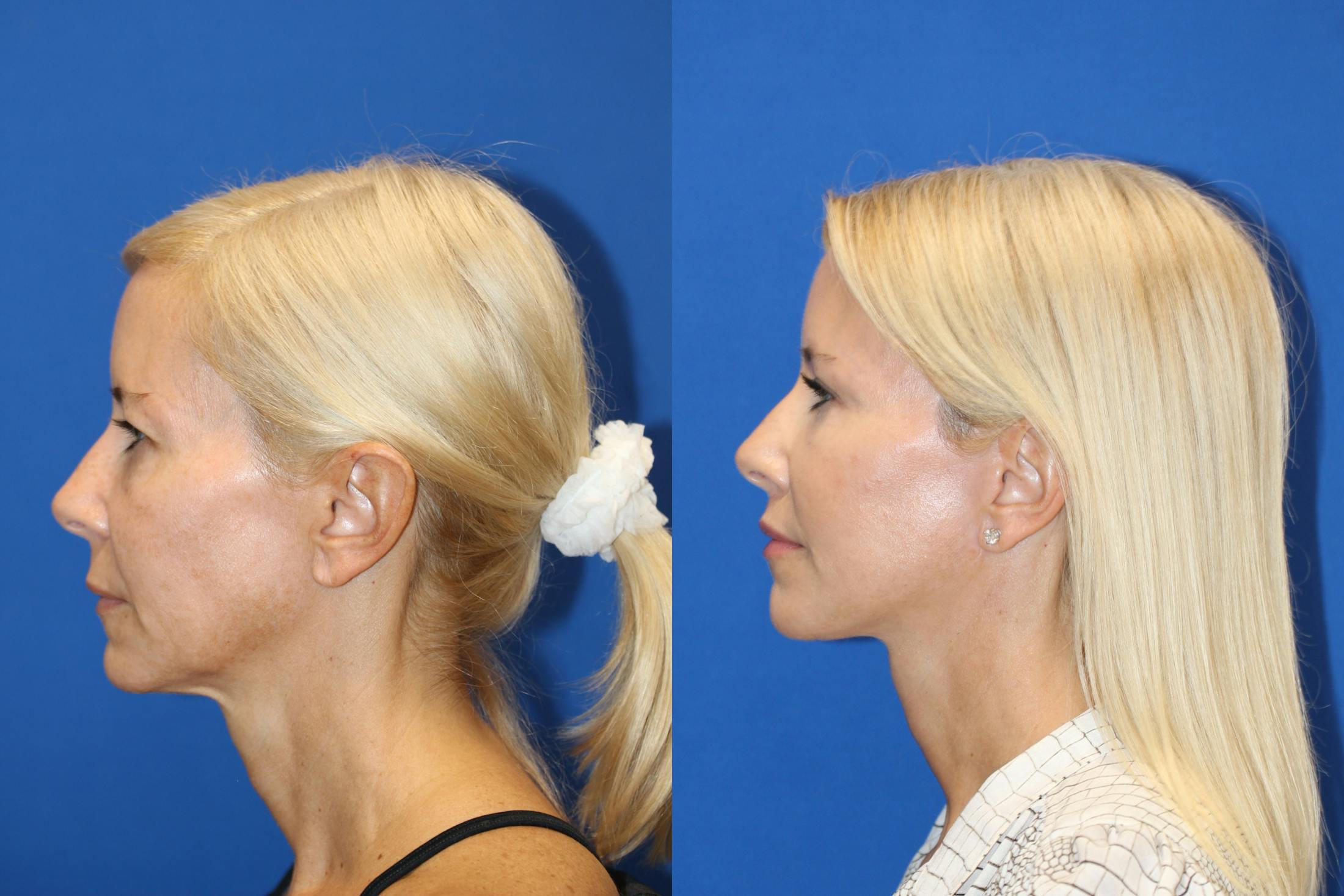 Lip Lift Before & After Gallery - Patient 83244759 - Image 4