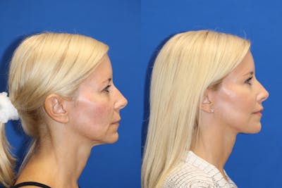 Neck Lift Before & After Gallery - Patient 85179028 - Image 1