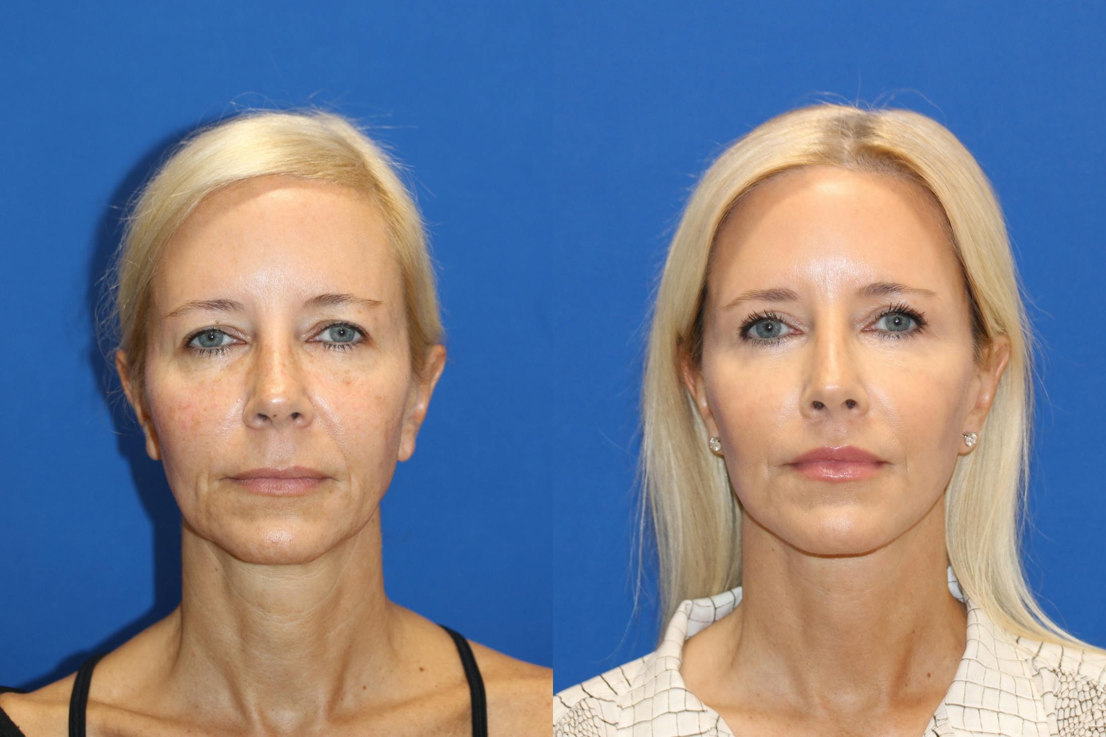 Neck Lift Before & After Gallery - Patient 85179028 - Image 5
