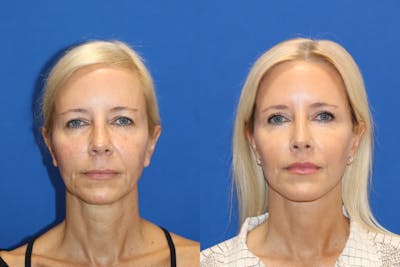 Vertical Restore® / Facial Rejuvenation Before & After Gallery - Patient 77320119 - Image 1