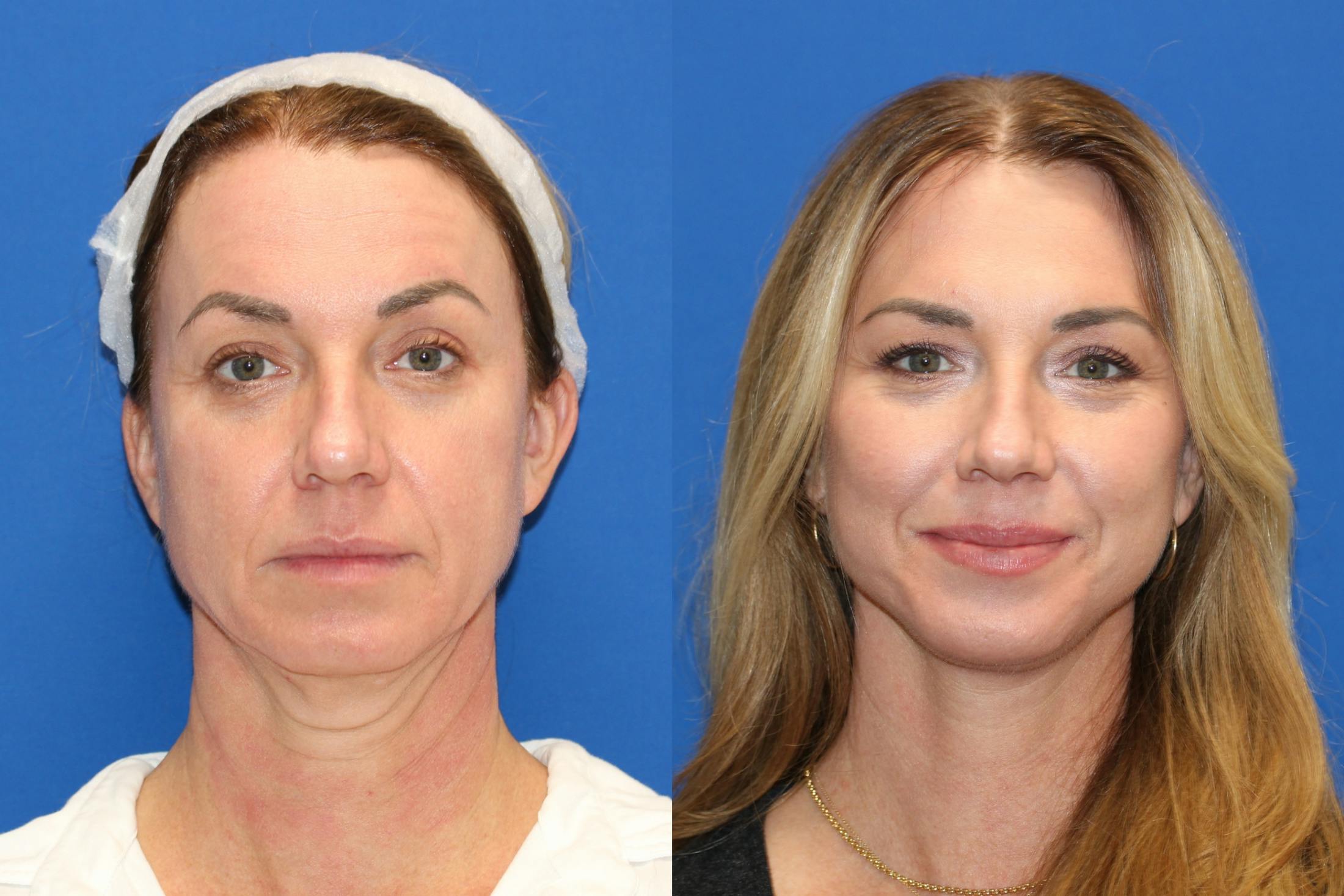 Vertical Restore® / Facial Rejuvenation Before & After Gallery - Patient 77320112 - Image 1