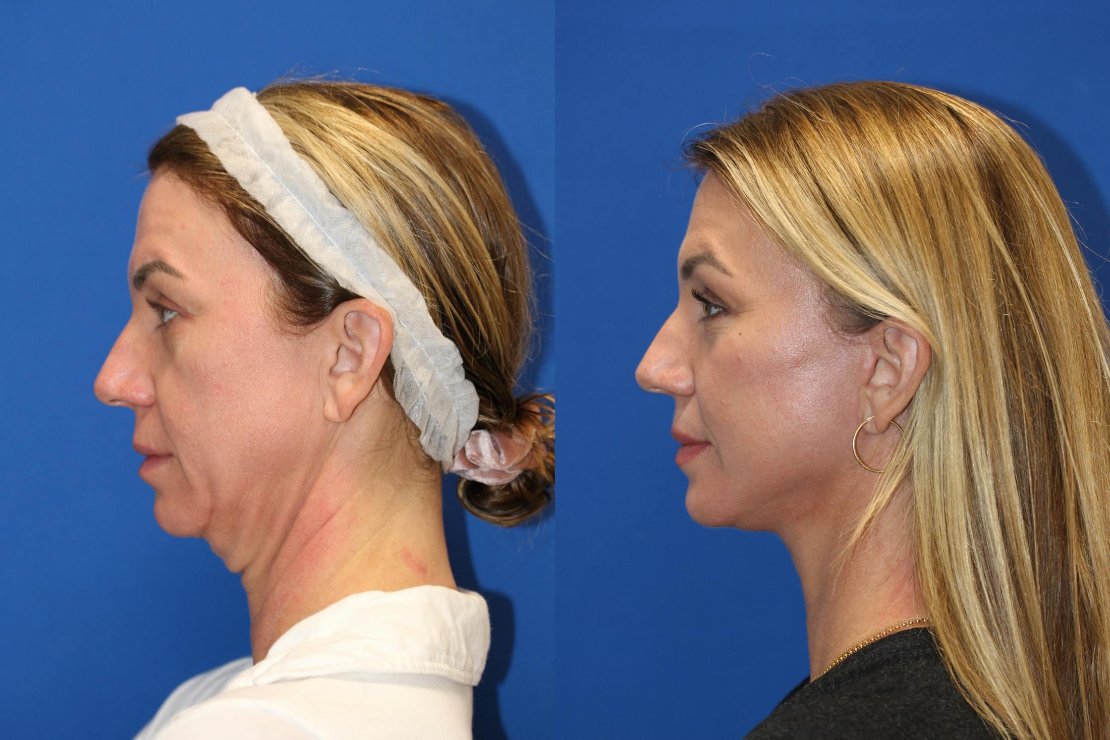 Vertical Restore® / Facial Rejuvenation Before & After Gallery - Patient 77320112 - Image 4