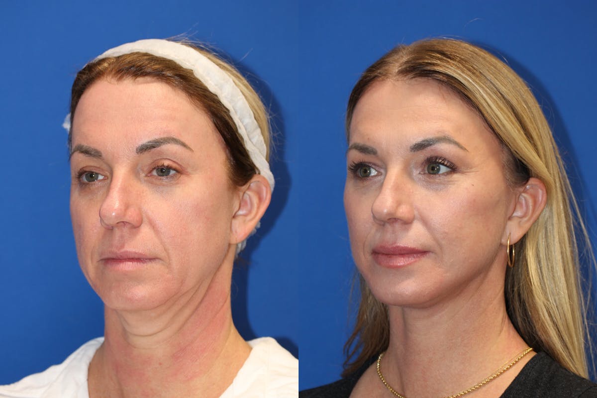 Neck Lift Before & After Gallery - Patient 85179071 - Image 4