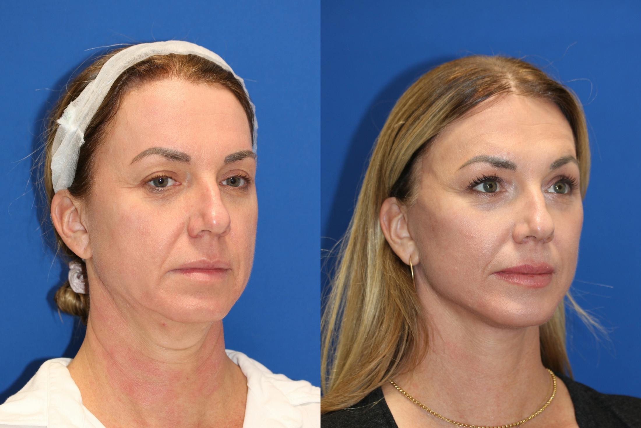 Vertical Restore® / Facial Rejuvenation Before & After Gallery - Patient 77320112 - Image 3