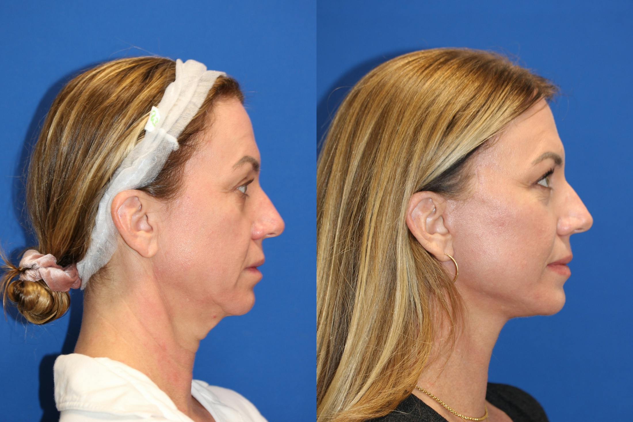 Neck Lift Before & After Gallery - Patient 85179071 - Image 1
