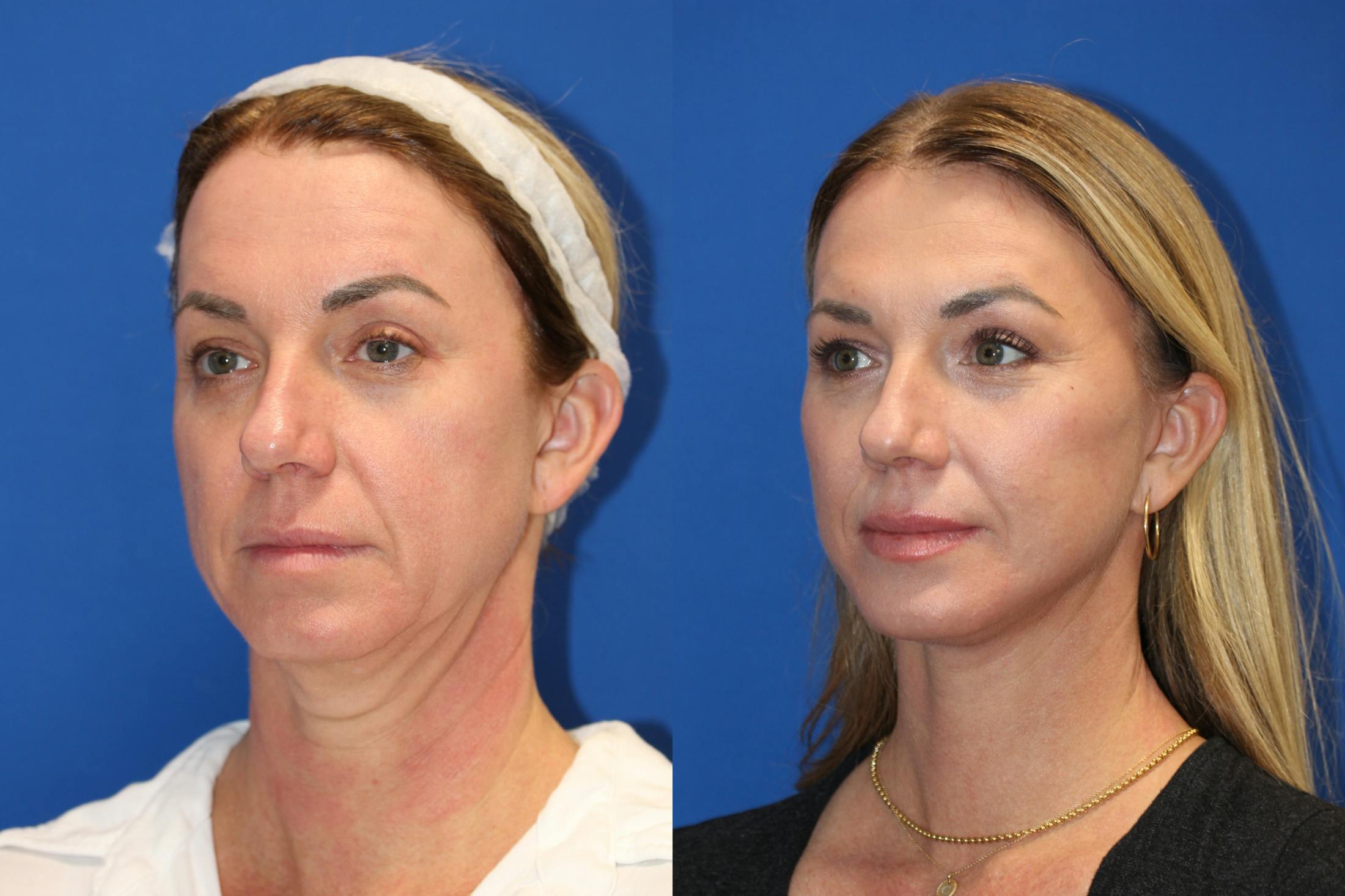 Vertical Restore® / Facial Rejuvenation Before & After Gallery - Patient 77320112 - Image 2