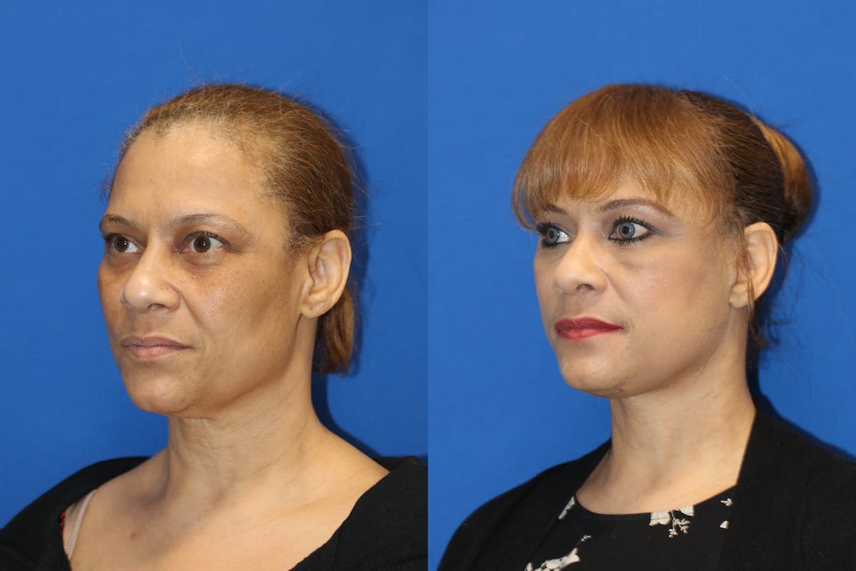 Vertical Restore® / Facial Rejuvenation Before & After Gallery - Patient 79796652 - Image 3