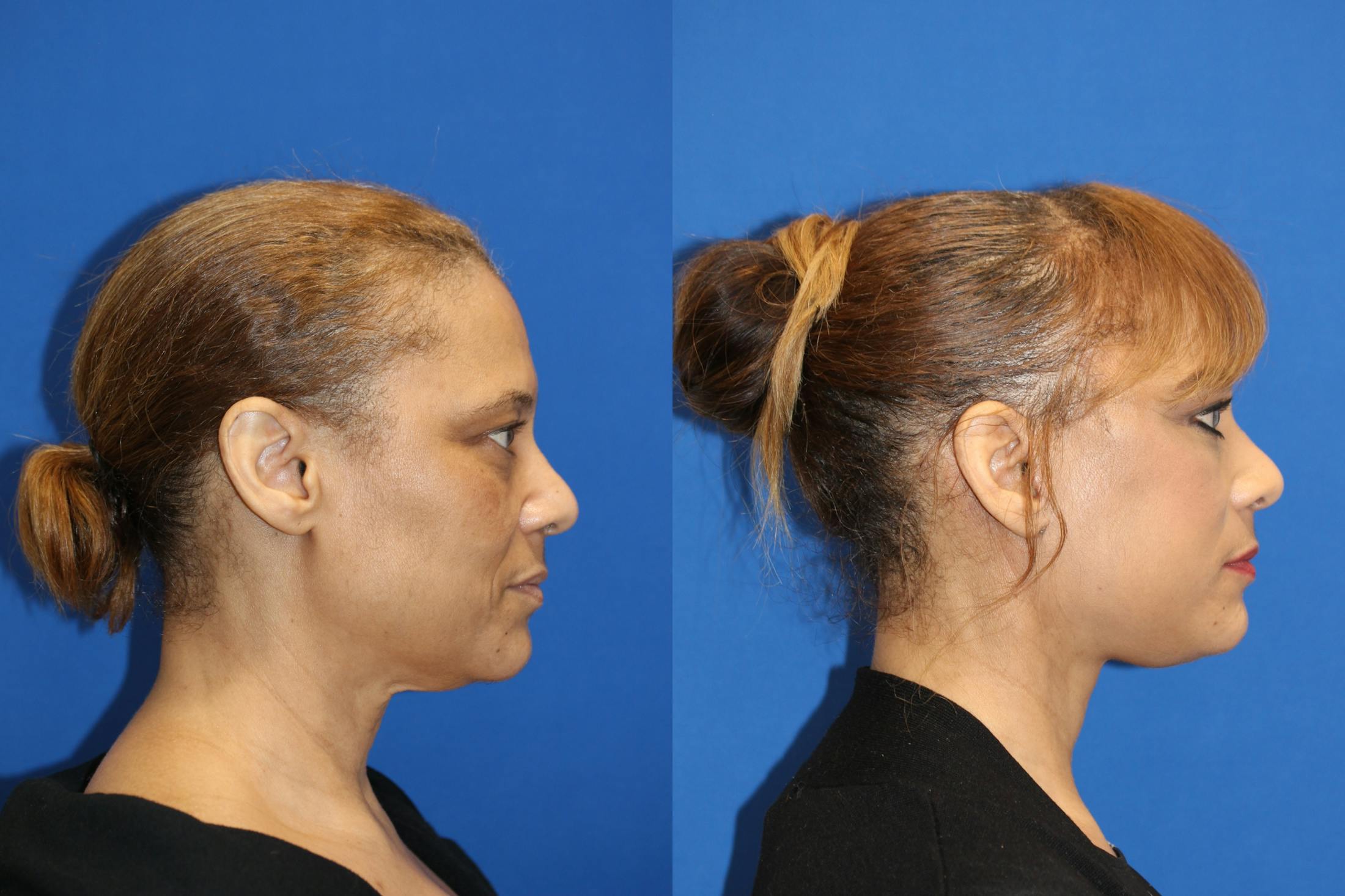 Vertical Restore® / Facial Rejuvenation Before & After Gallery - Patient 79796652 - Image 2
