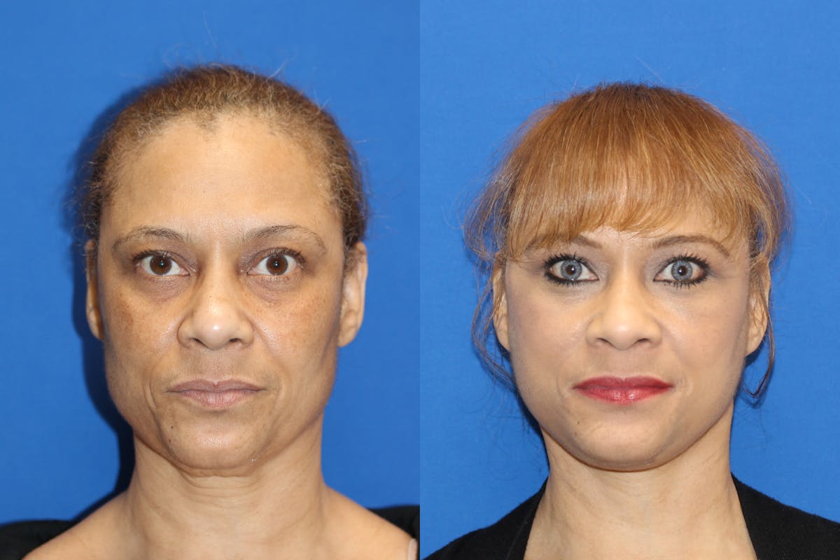 Vertical Restore® / Facial Rejuvenation Before & After Gallery - Patient 79796652 - Image 1