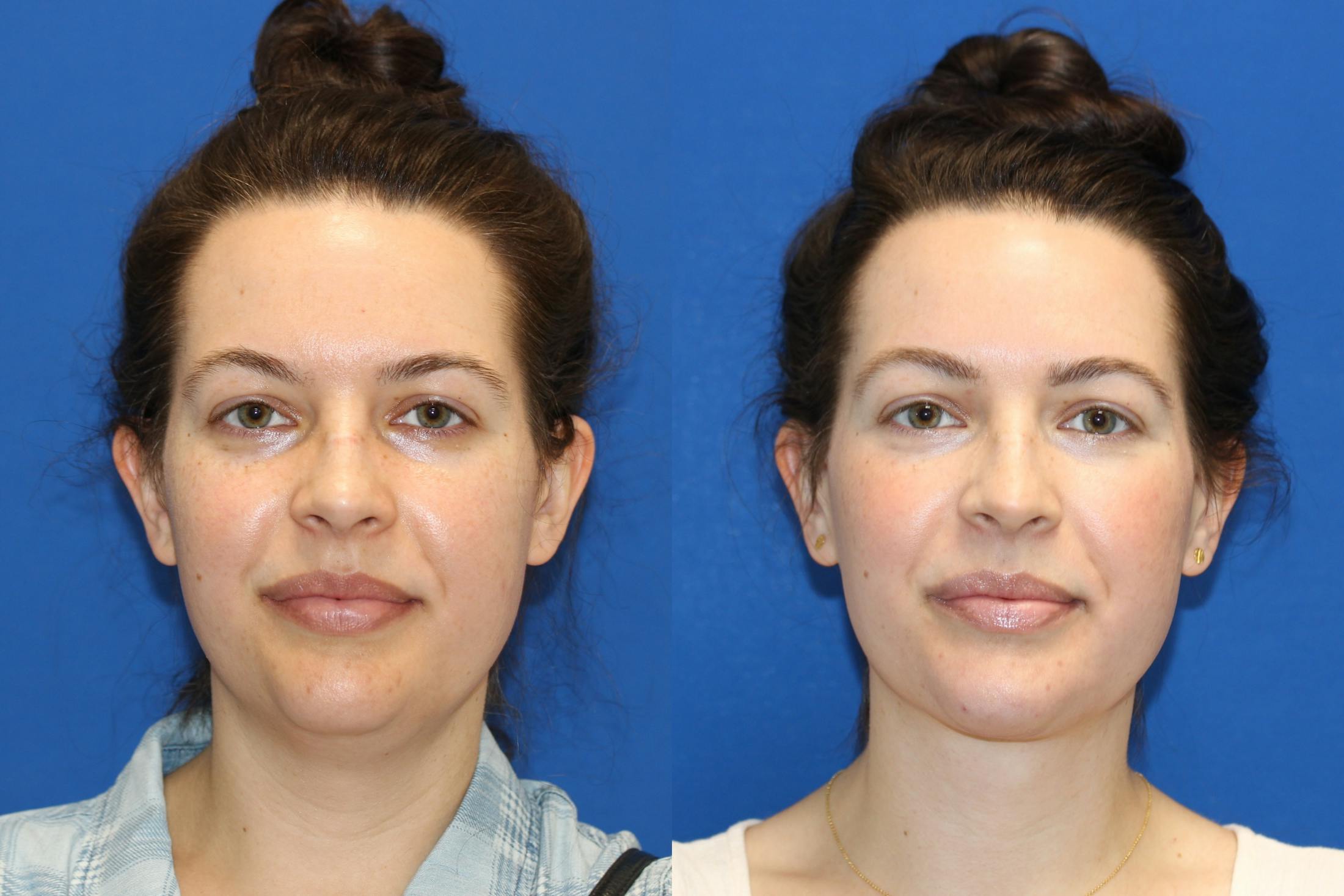Vertical Restore® / Facial Rejuvenation Before & After Gallery - Patient 79797080 - Image 1