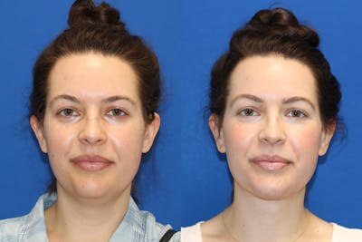 Vertical Restore® / Facial Rejuvenation Gallery - Patient 79797080 - Image 1
