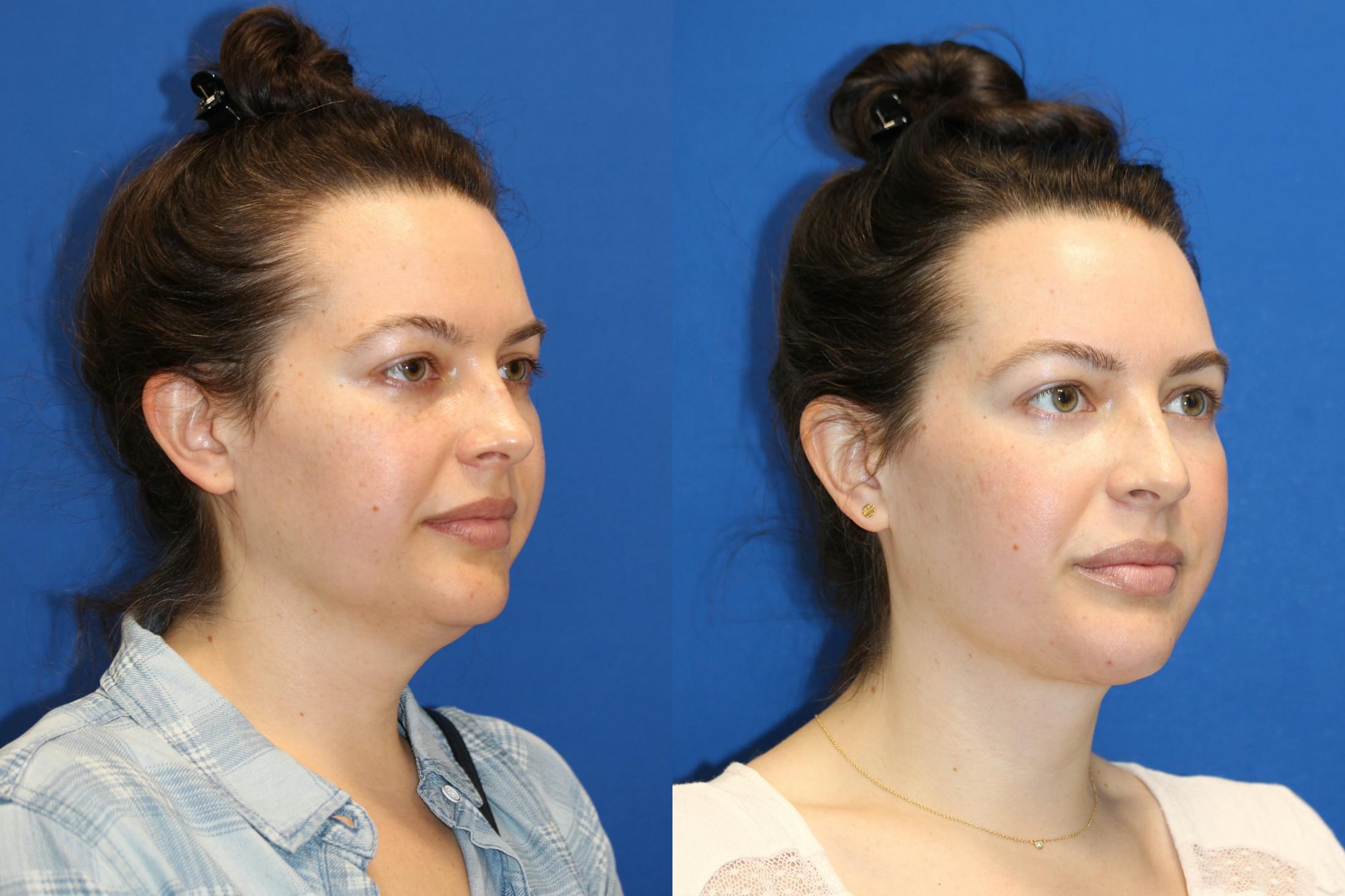 Neck Lift Before & After Gallery - Patient 85195585 - Image 2