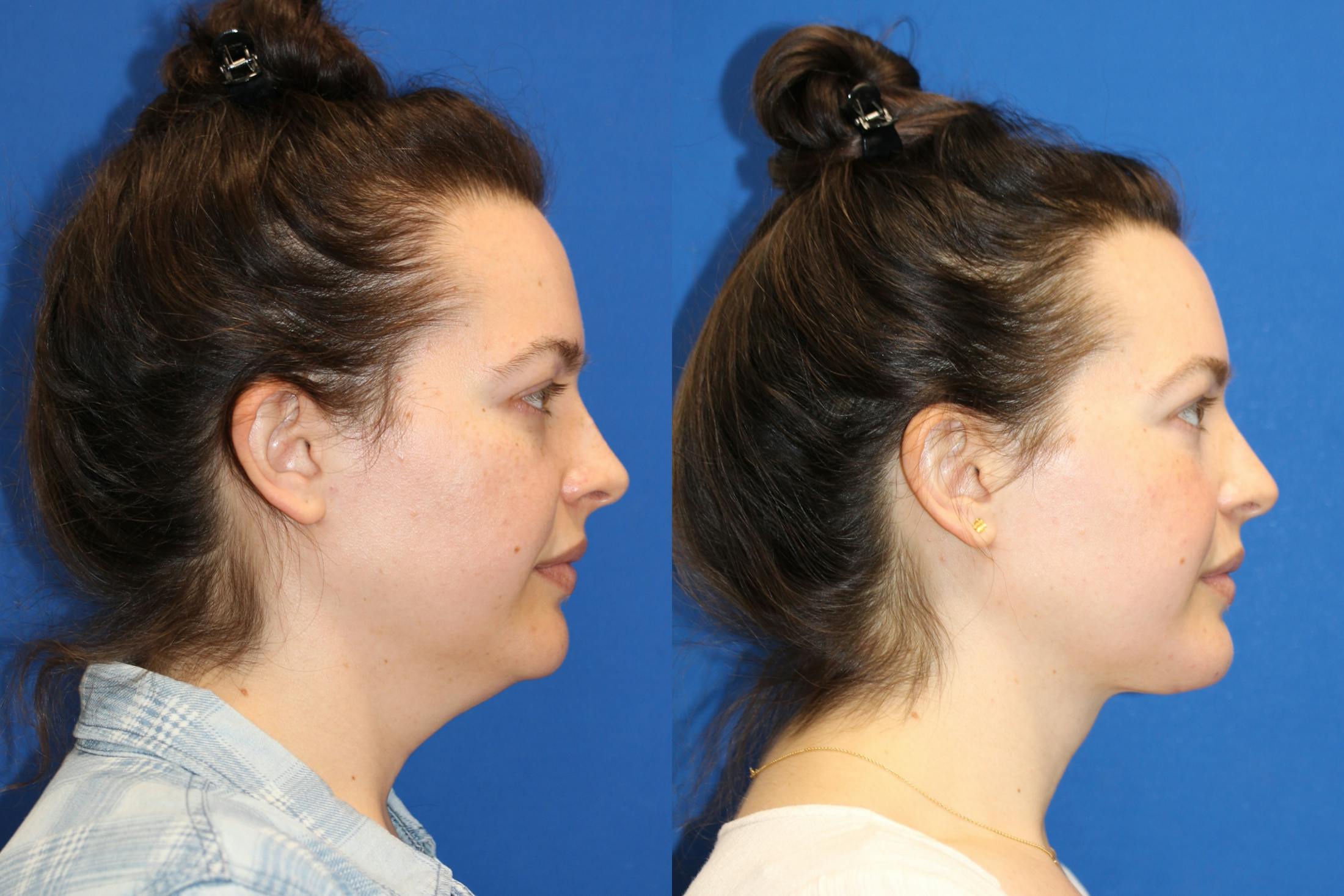 Neck Lift Before & After Gallery - Patient 85195585 - Image 1