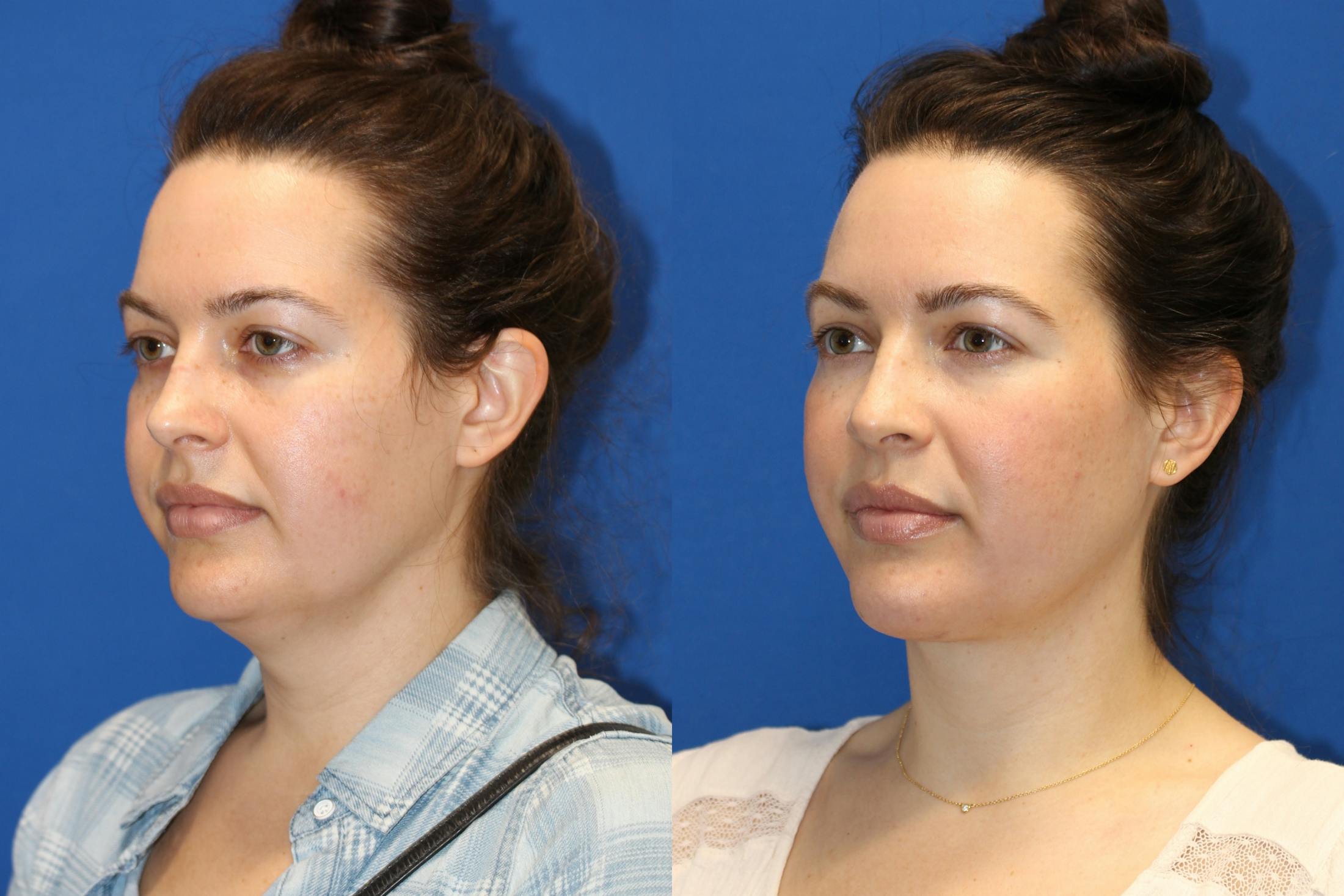 Neck Lift Before & After Gallery - Patient 85195585 - Image 4