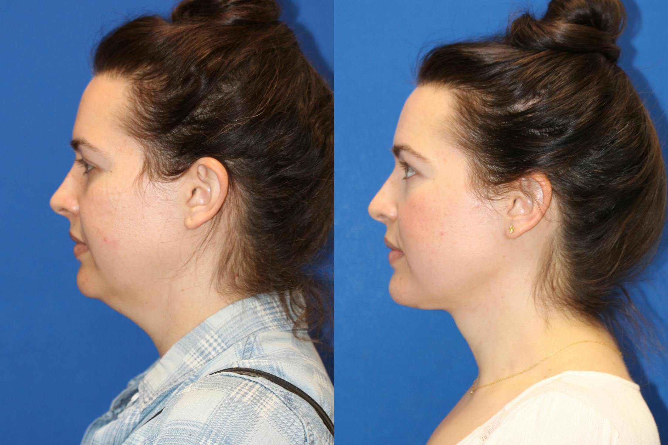 Neck Lift Before & After Gallery - Patient 85195585 - Image 3