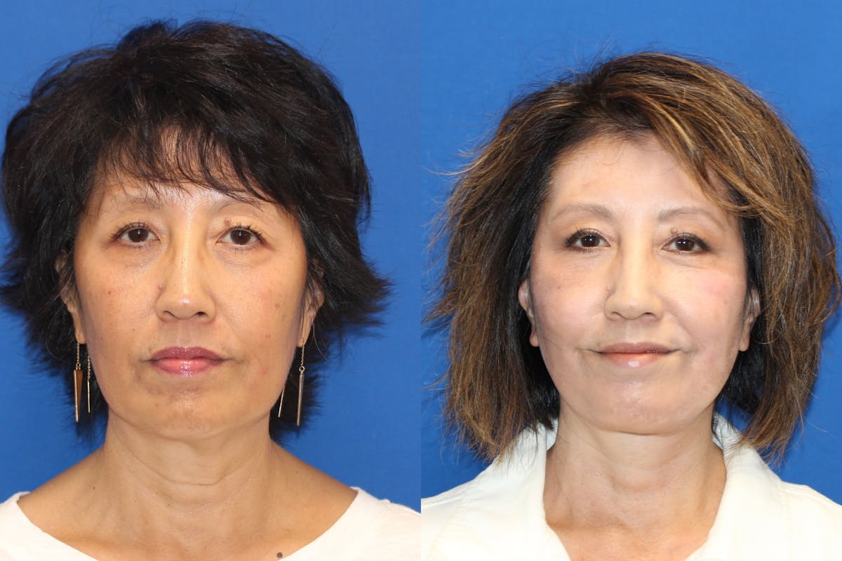 Vertical Restore® / Facial Rejuvenation Before & After Gallery - Patient 79797140 - Image 1