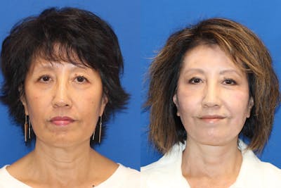 Vertical Restore® / Facial Rejuvenation Before & After Gallery - Patient 79797140 - Image 1