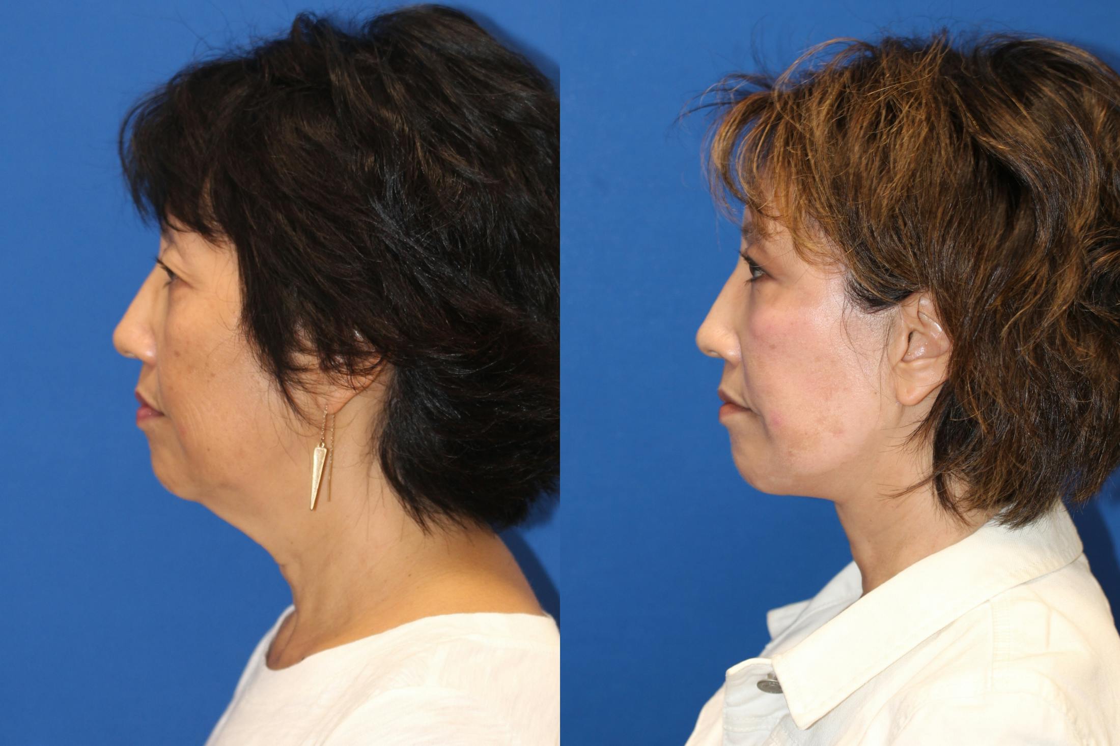 Fat Transfer Before & After Gallery - Patient 89273957 - Image 2