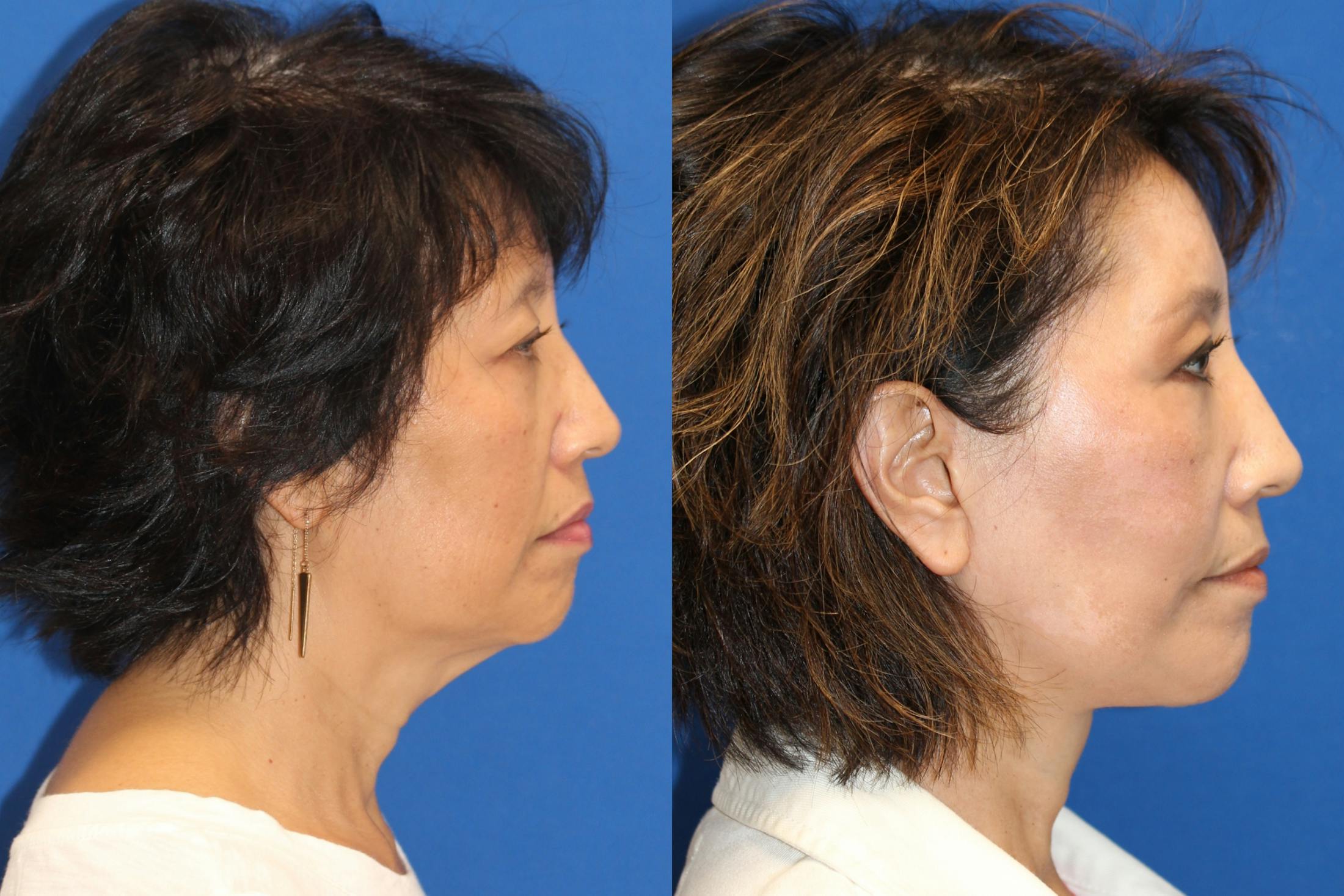 Neck Lift Before & After Gallery - Patient 85195598 - Image 1