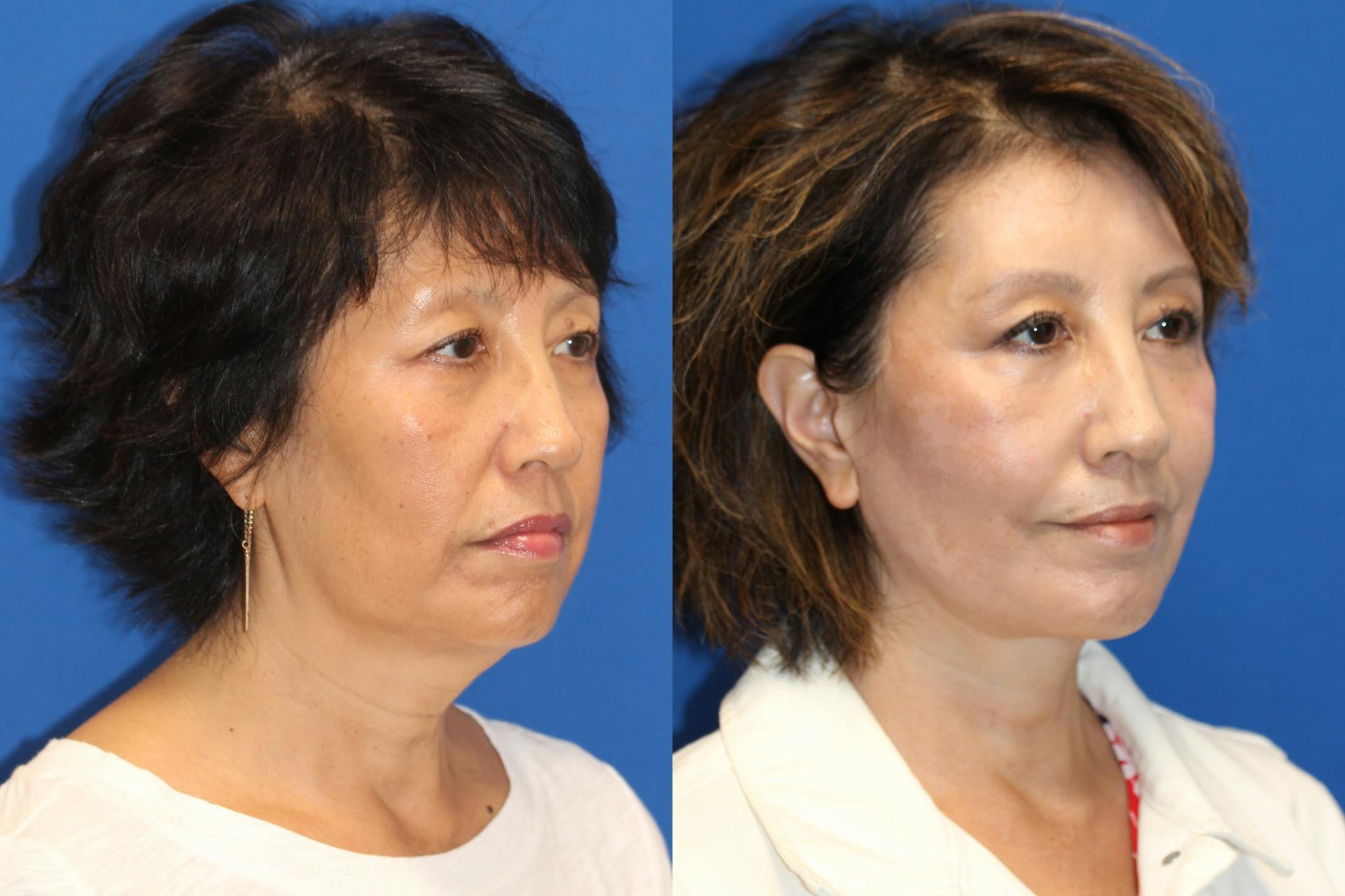 Vertical Restore® / Facial Rejuvenation Before & After Gallery - Patient 79797140 - Image 2