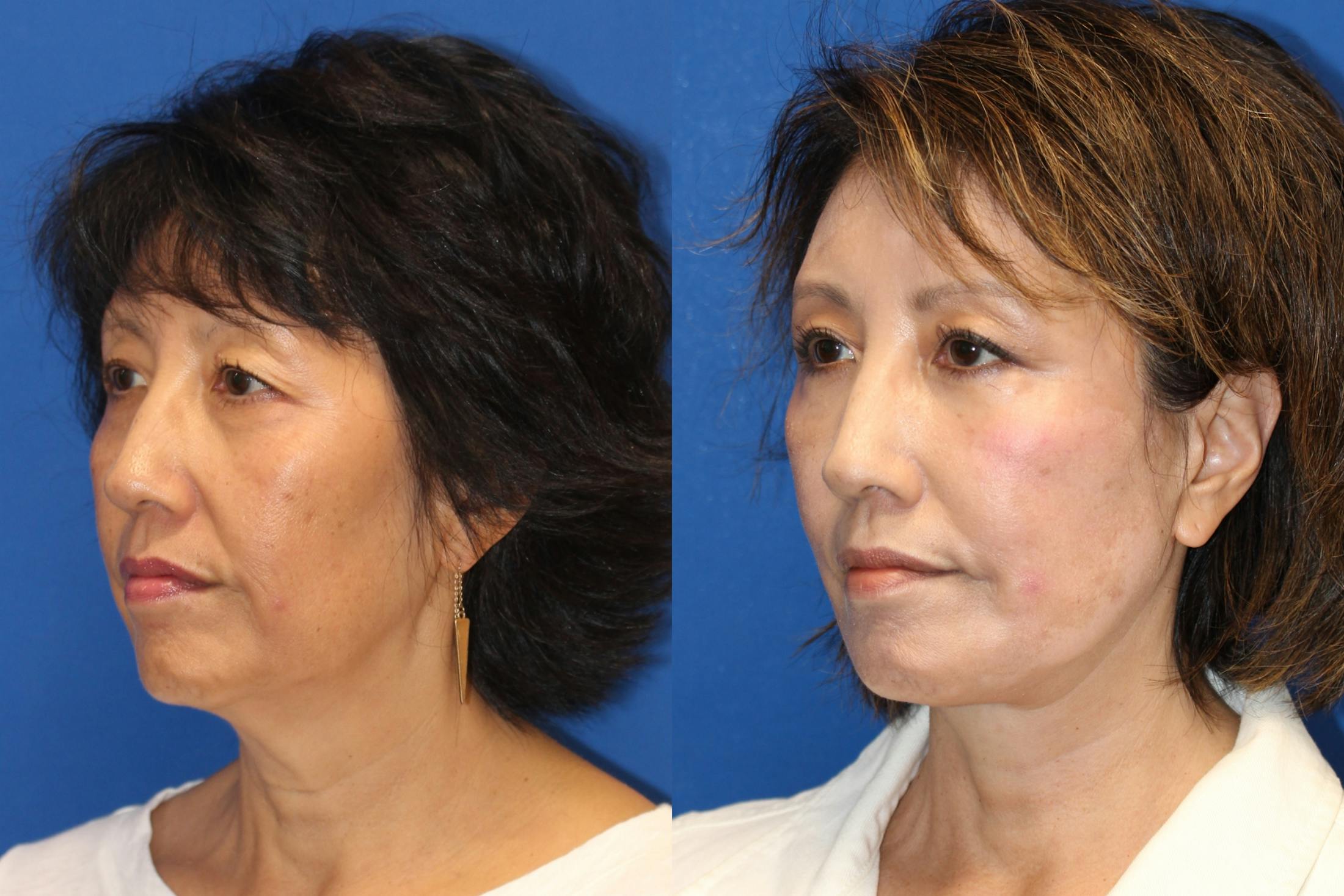 Vertical Restore® / Facial Rejuvenation Before & After Gallery - Patient 79797140 - Image 4