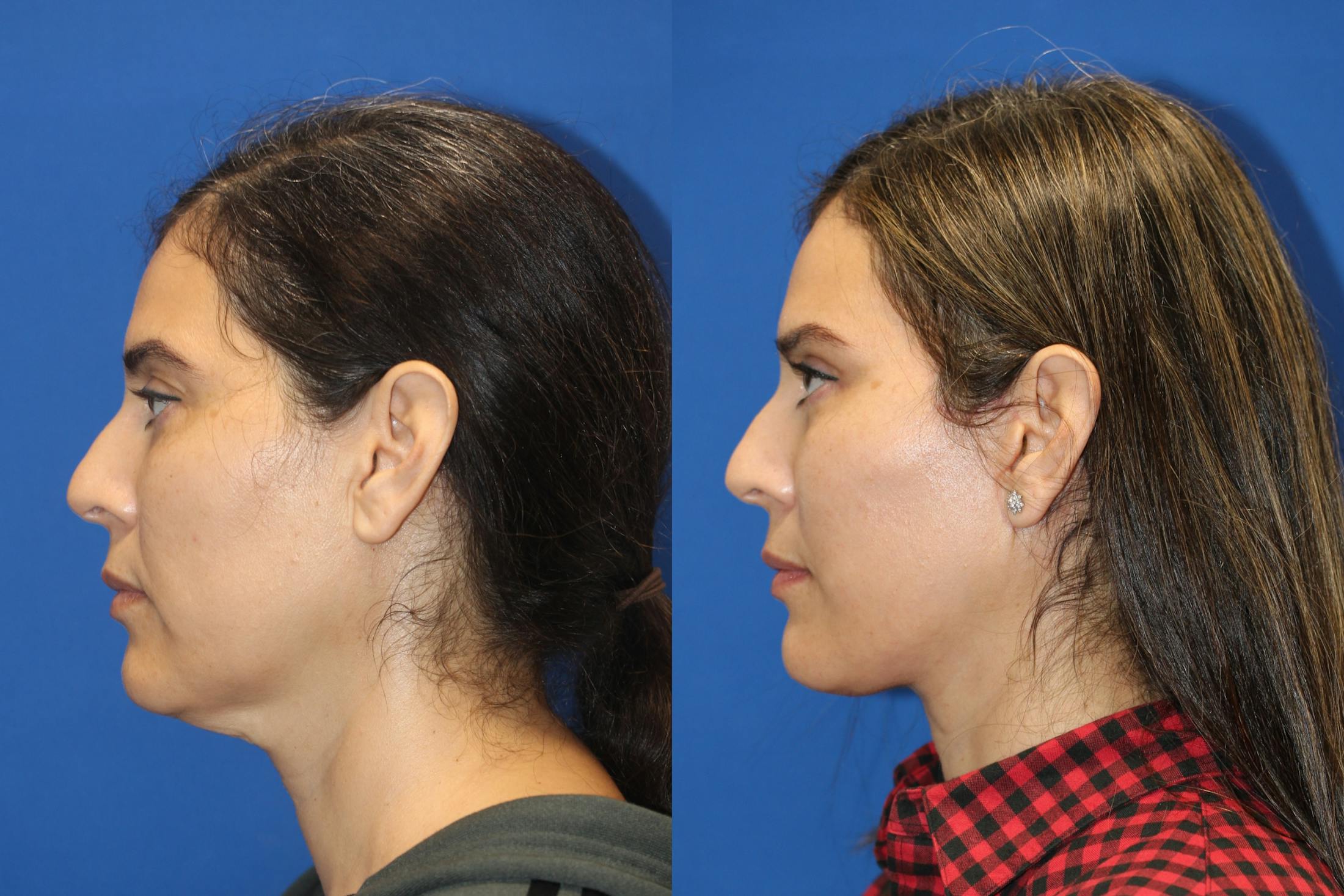Vertical Restore® / Facial Rejuvenation Before & After Gallery - Patient 79836311 - Image 4