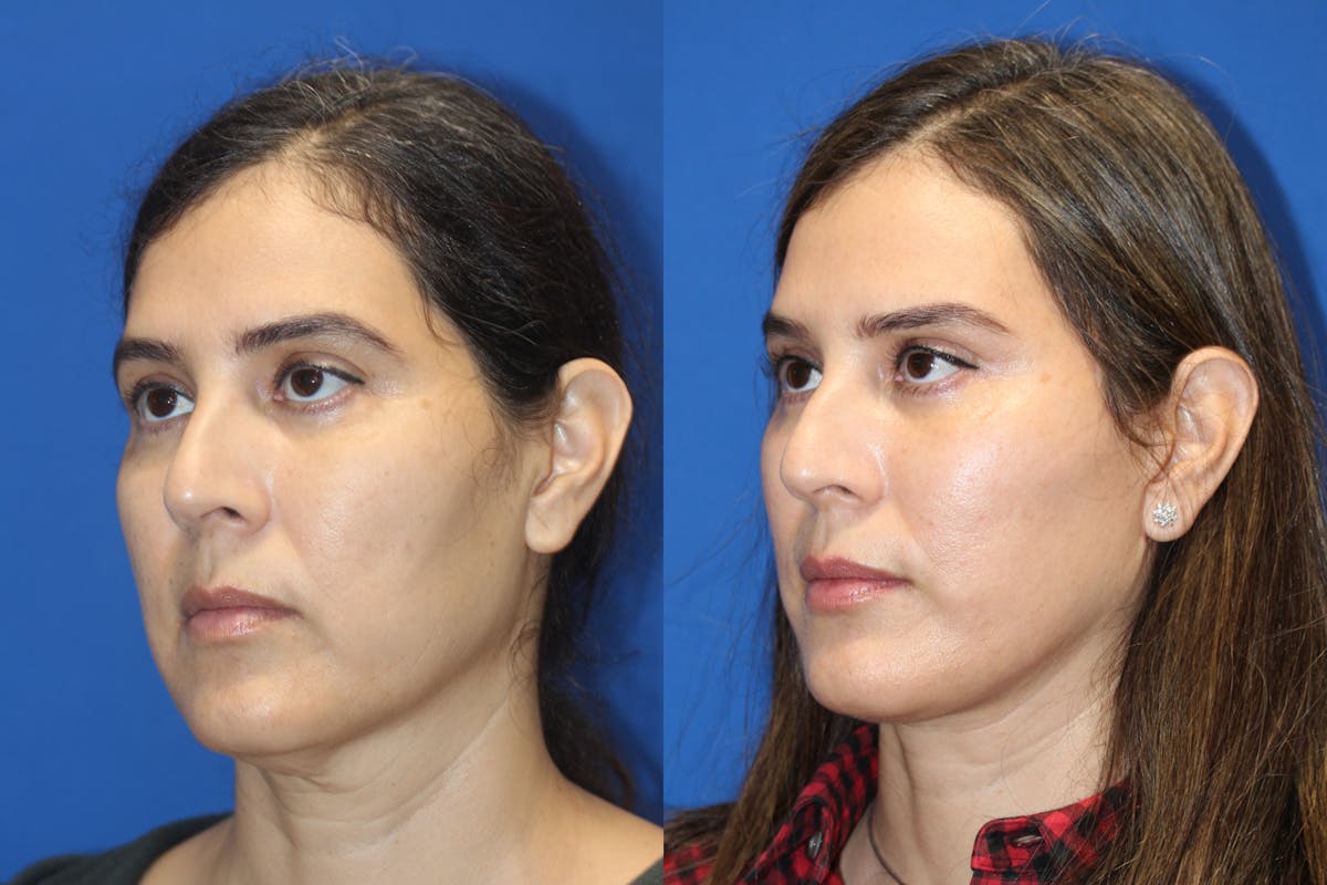 Vertical Restore® / Facial Rejuvenation Before & After Gallery - Patient 79836311 - Image 3