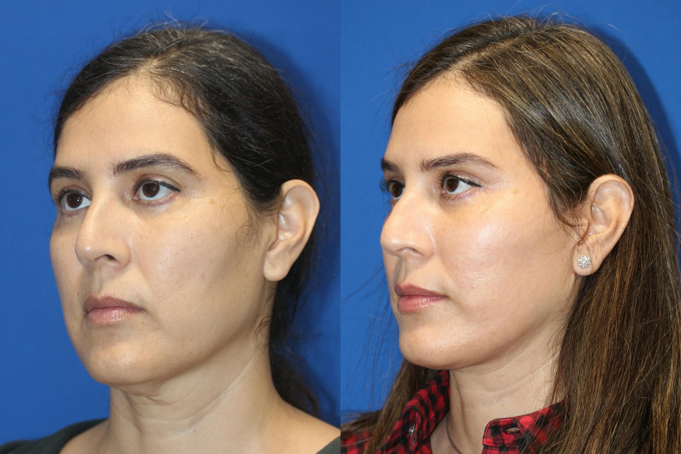 Vertical Restore® / Facial Rejuvenation Before & After Gallery - Patient 79836311 - Image 2