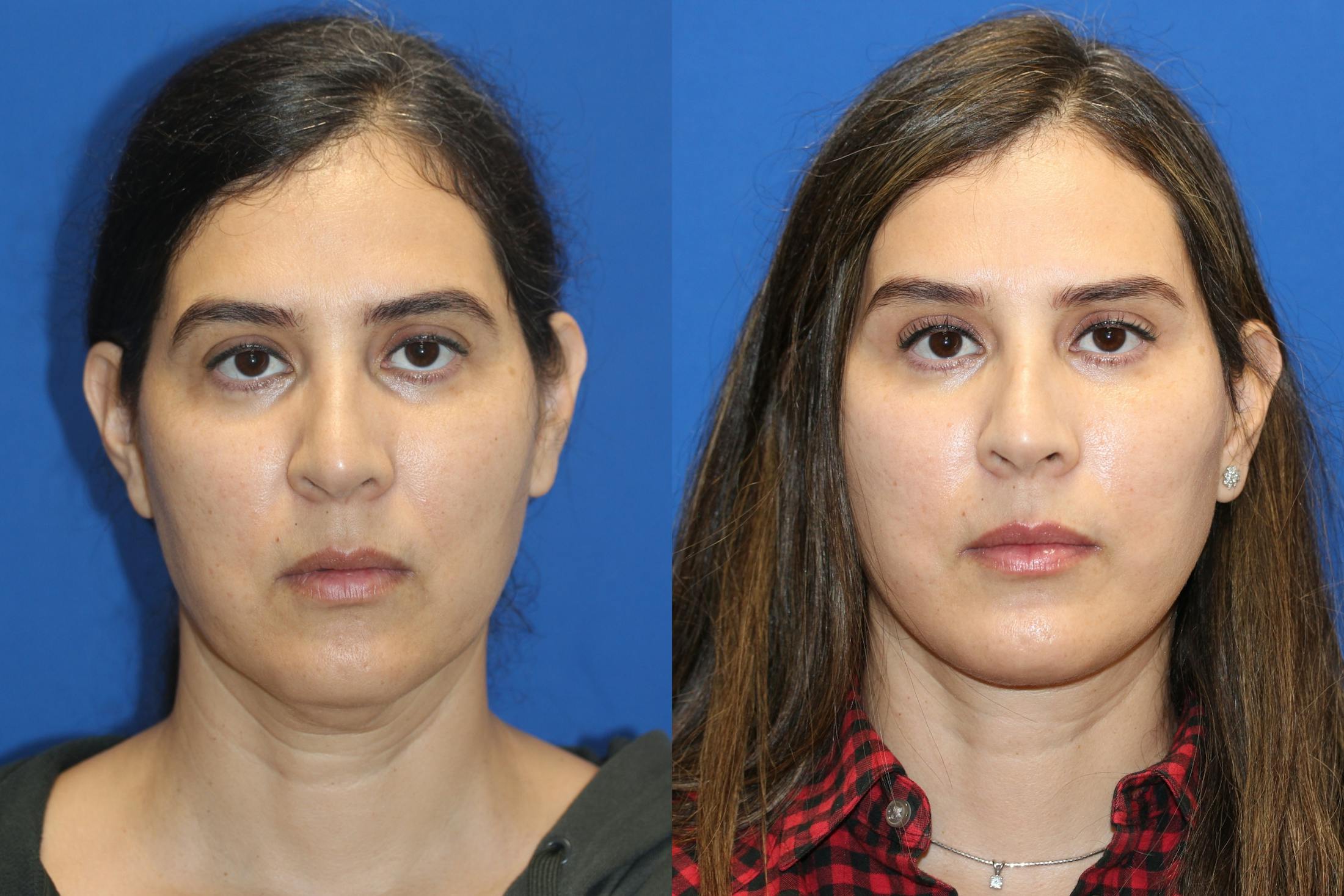 Vertical Restore® / Facial Rejuvenation Before & After Gallery - Patient 79836311 - Image 1