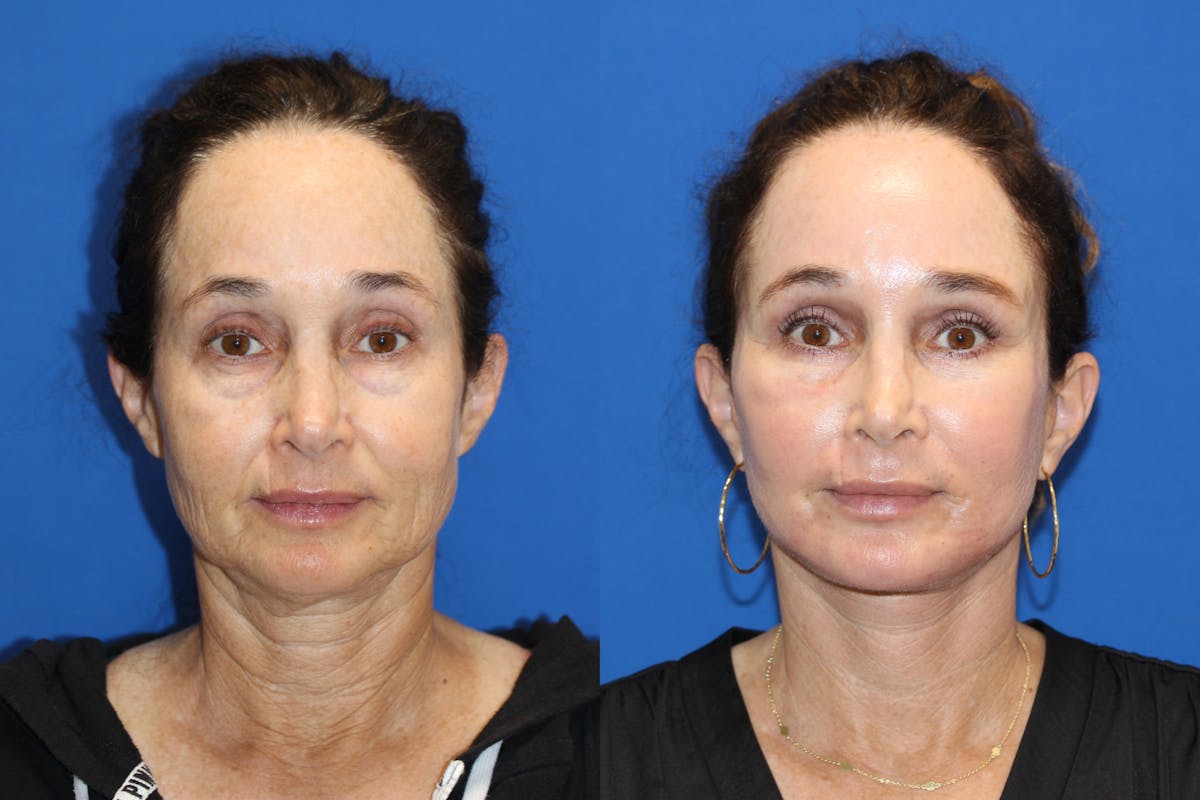 Vertical Restore® / Facial Rejuvenation Before & After Gallery - Patient 71700598 - Image 1