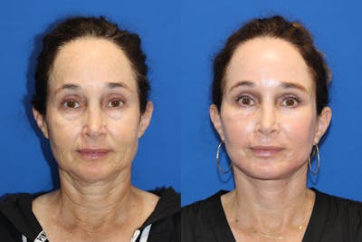 Fat Transfer Before & After Gallery - Patient 89289781 - Image 1