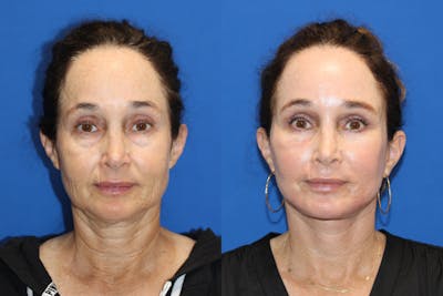 Fat Transfer Before & After Gallery - Patient 89289781 - Image 1