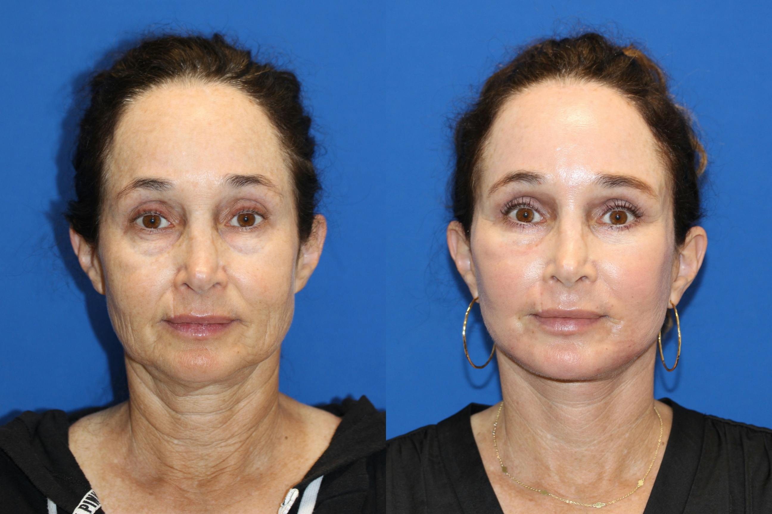 Vertical Restore® / Facial Rejuvenation Gallery - Patient 71700598 - Image 1