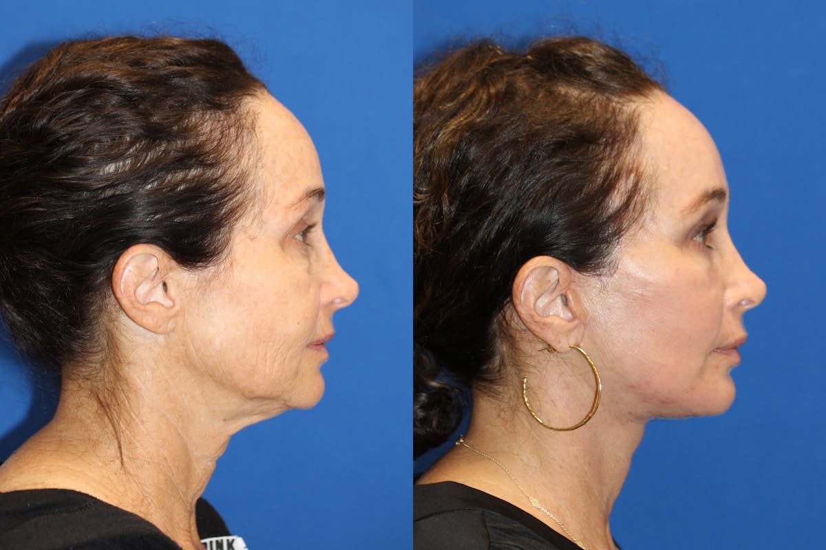 Fat Transfer Before & After Gallery - Patient 89289781 - Image 3