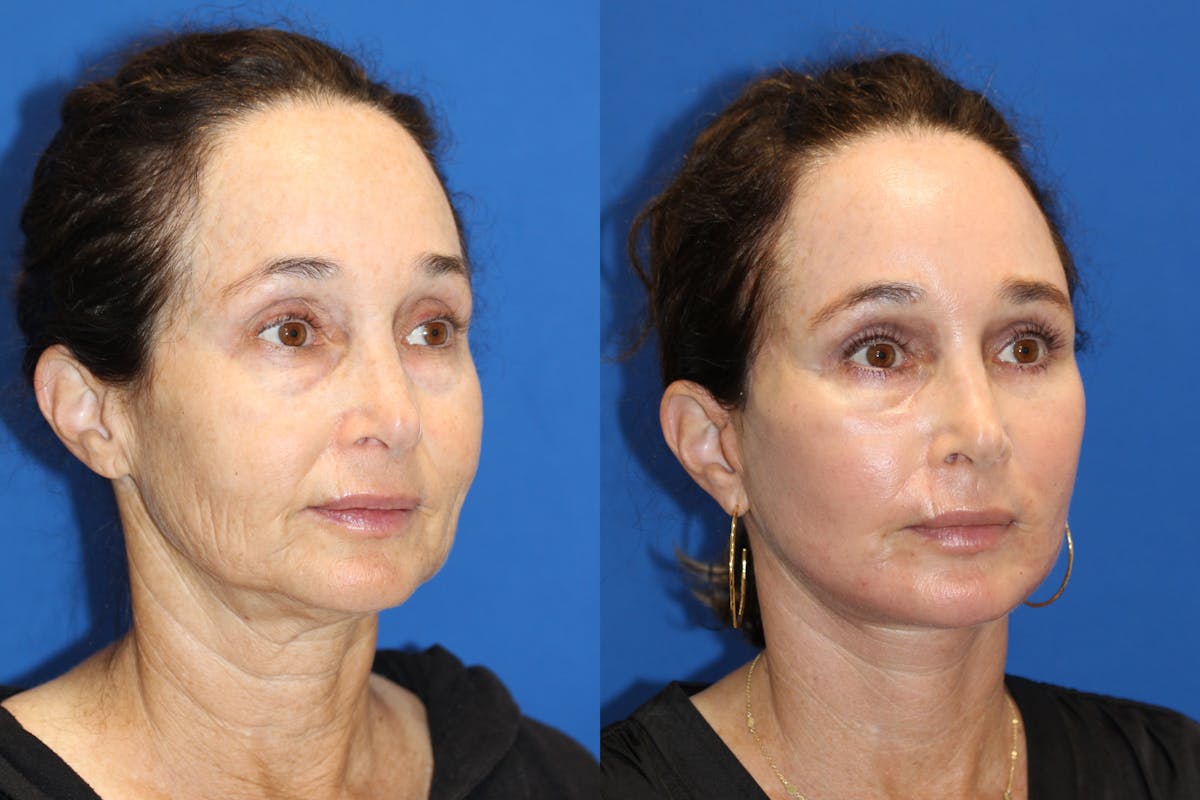 Vertical Restore® / Facial Rejuvenation Before & After Gallery - Patient 71700598 - Image 2