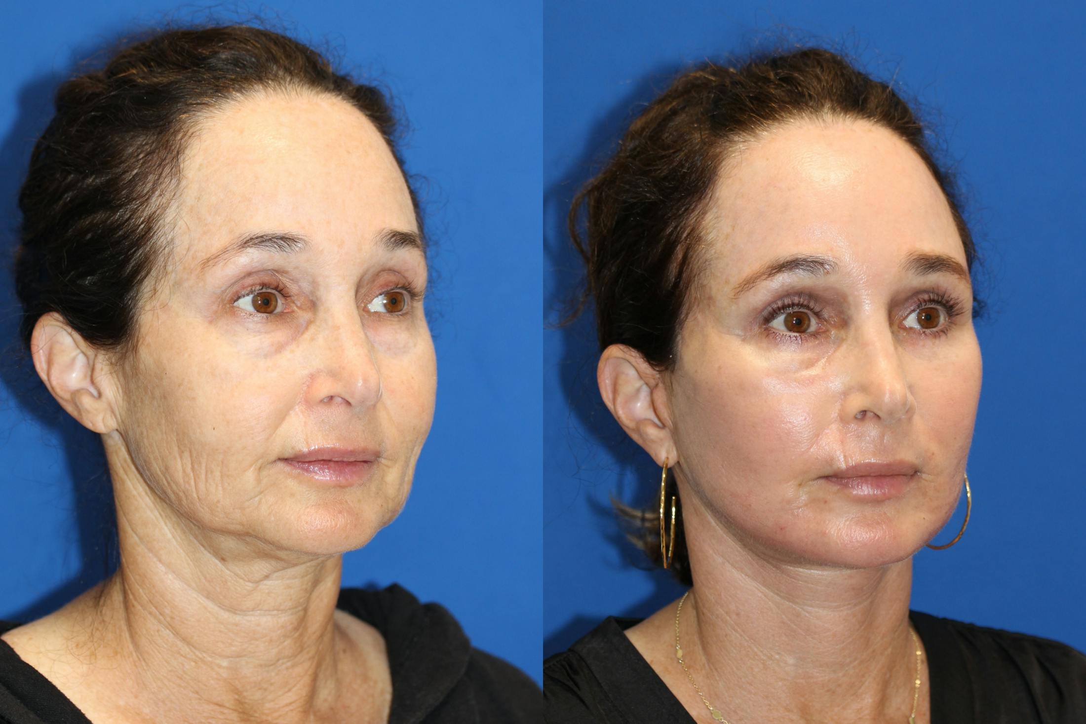 Vertical Restore® / Facial Rejuvenation Gallery - Patient 71700598 - Image 2