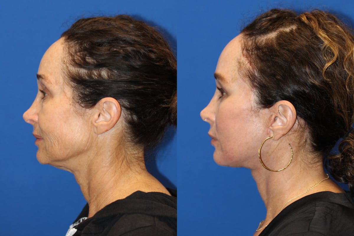Vertical Restore® / Facial Rejuvenation Before & After Gallery - Patient 71700598 - Image 5