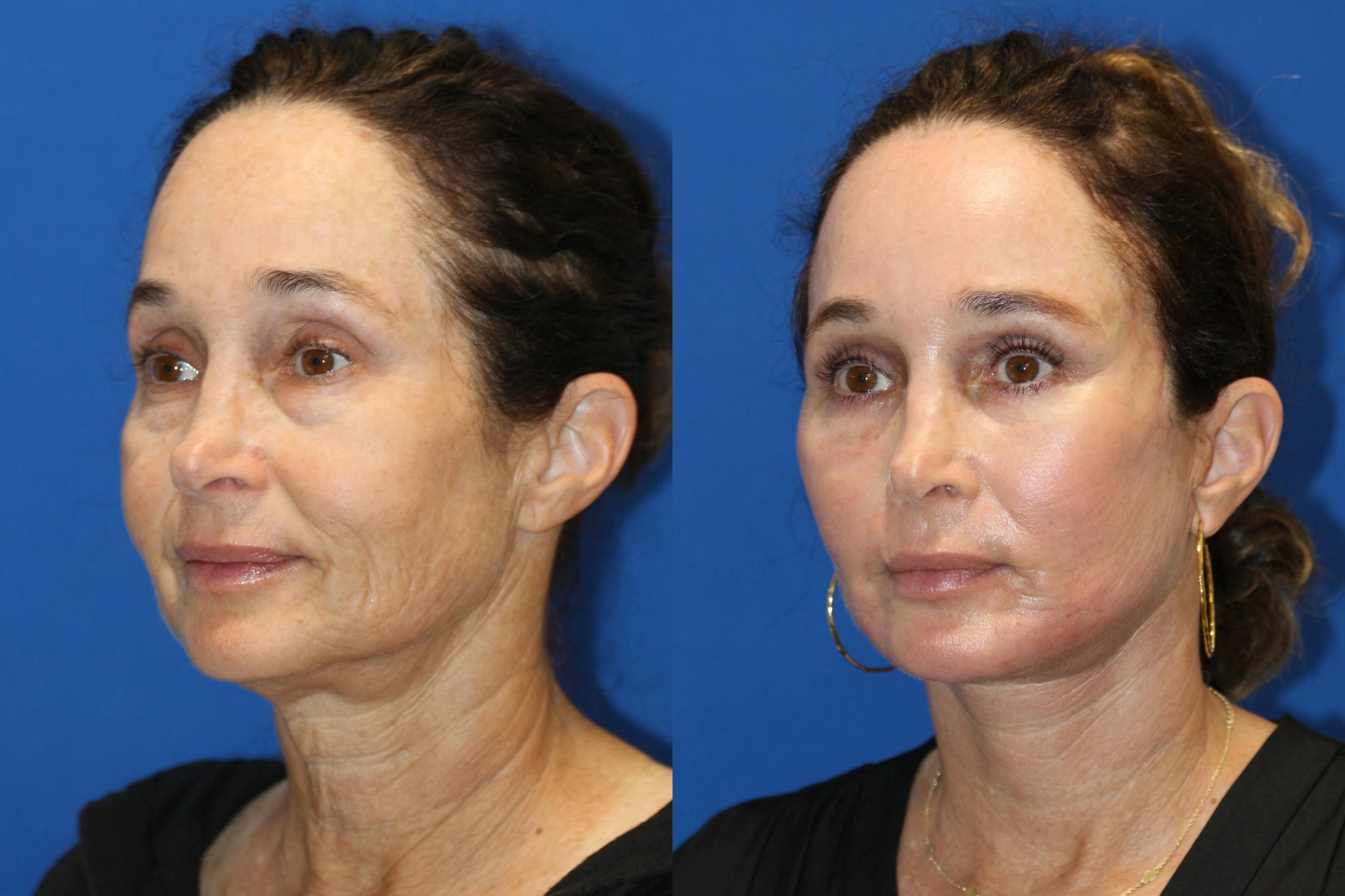 Vertical Restore® / Facial Rejuvenation Before & After Gallery - Patient 71700598 - Image 4