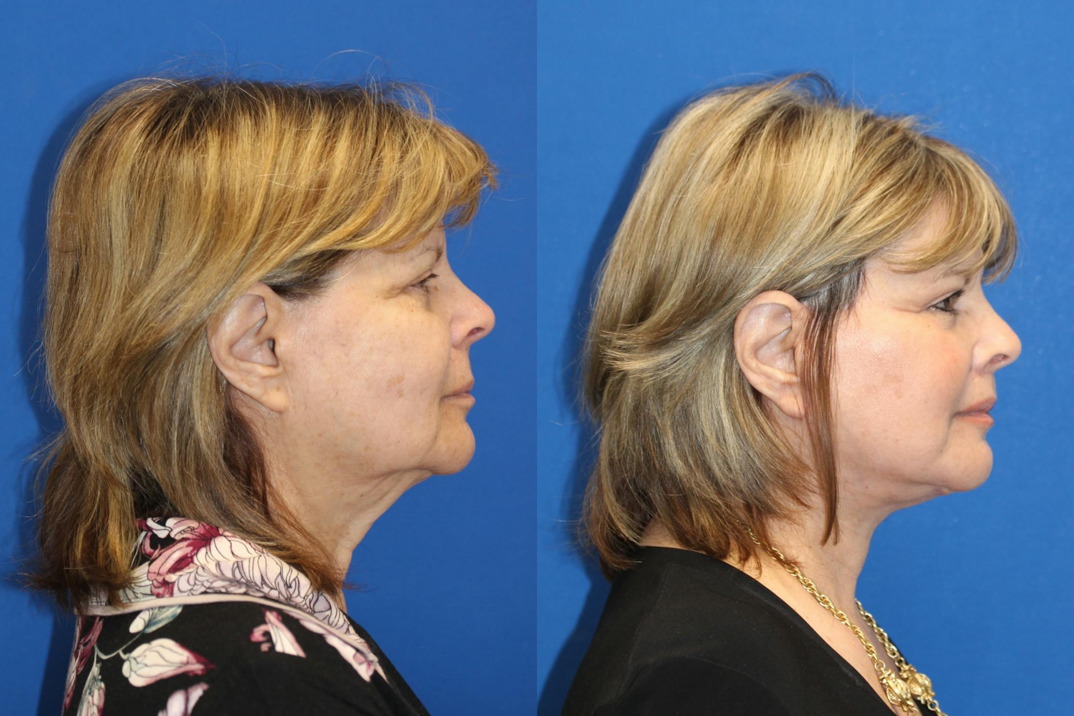 Neck Lift Before & After Gallery - Patient 85195610 - Image 1