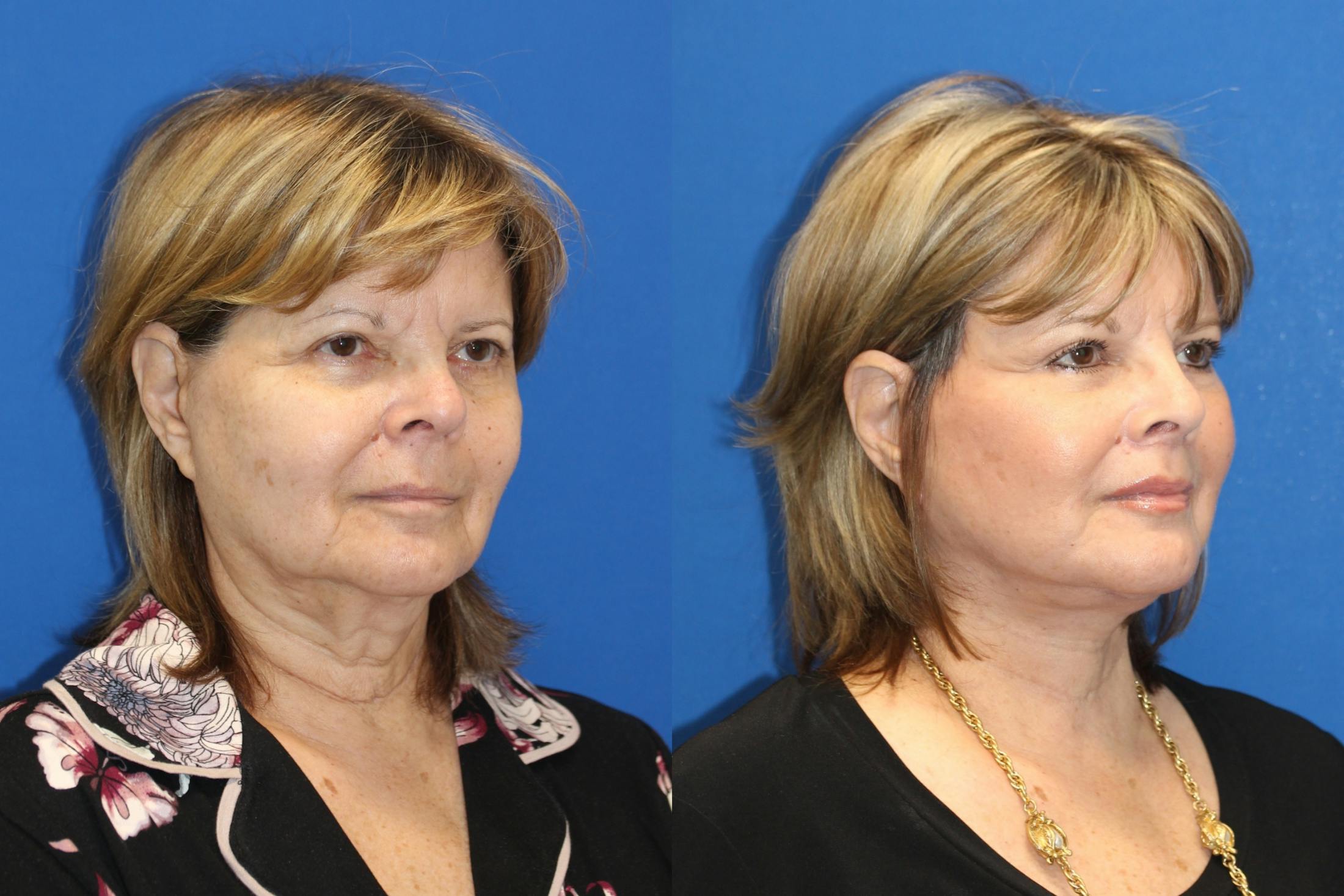 Neck Lift Before & After Gallery - Patient 85195610 - Image 2