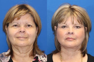 Lip Lift Before & After Gallery - Patient 83244800 - Image 1