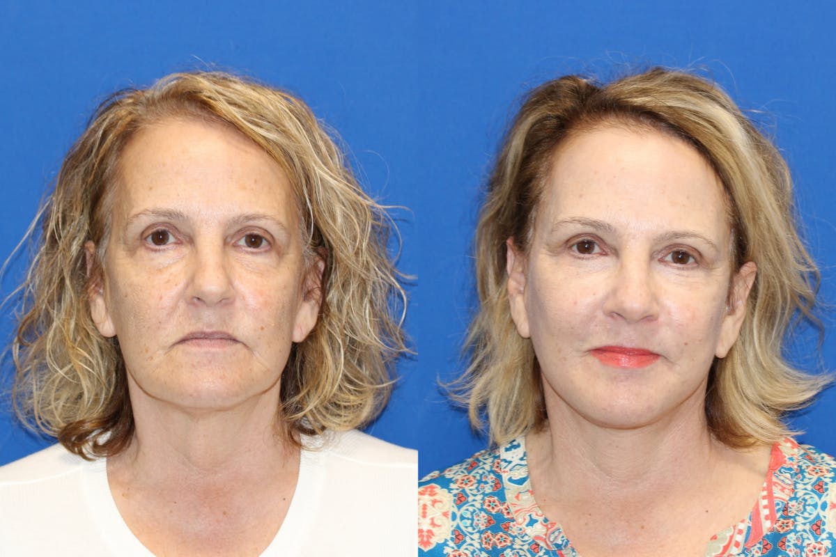 Vertical Restore® / Facial Rejuvenation Before & After Gallery - Patient 79839094 - Image 1