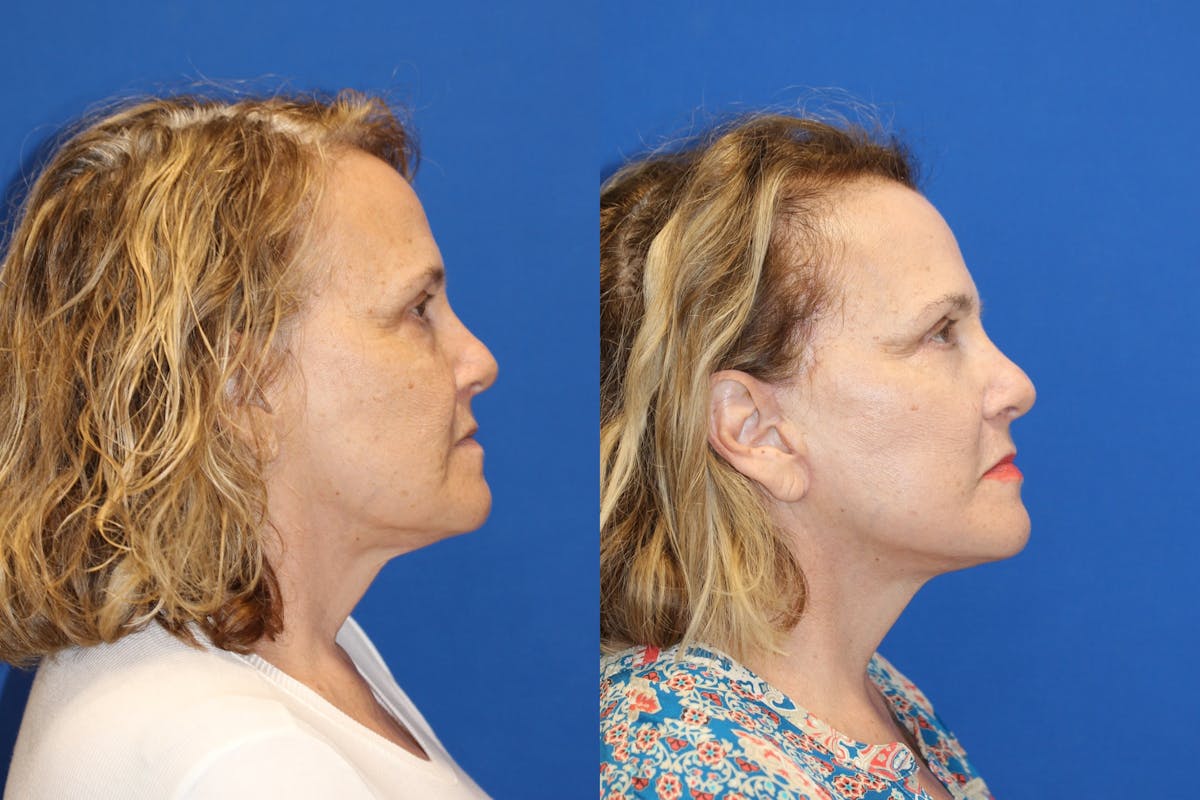 Fat Transfer Before & After Gallery - Patient 91507285 - Image 3